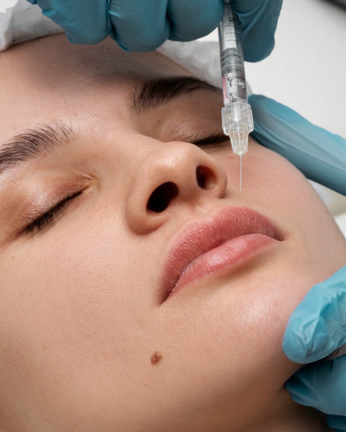 Dermal filler treatment at The One Clinic Leicester