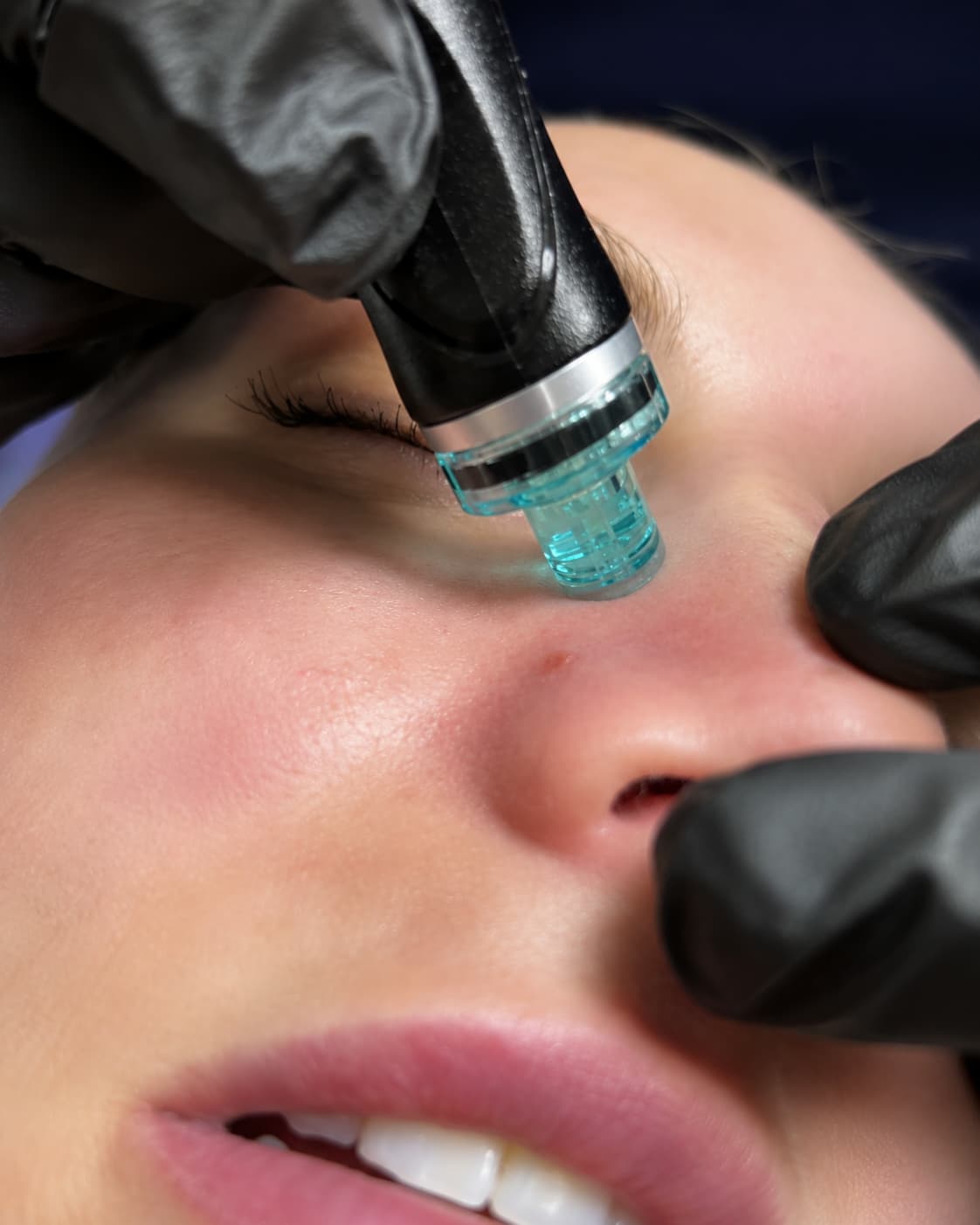 HydraFacial Keravive scalp treatment at The One Clinic Leicester