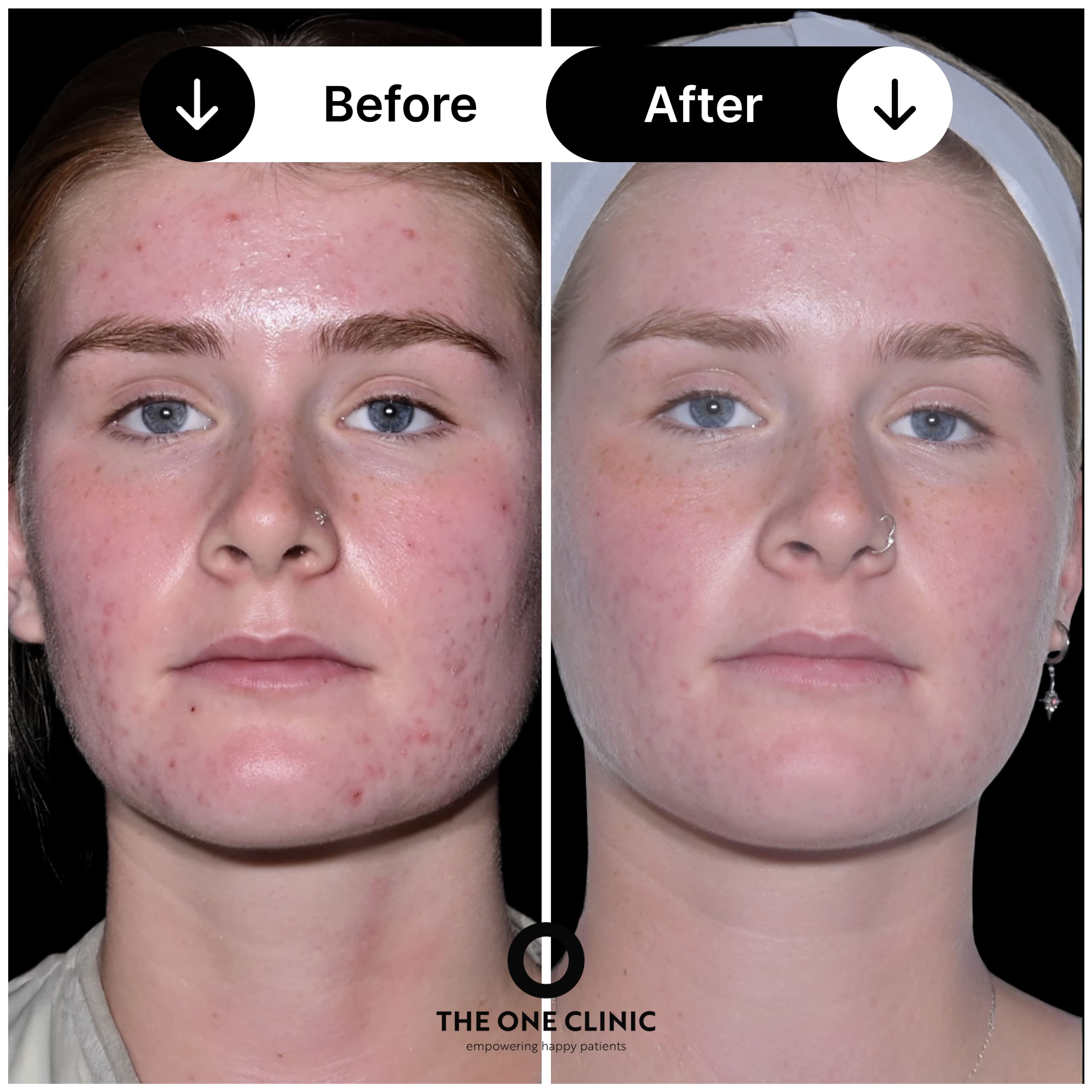 Acne treatment before and after results