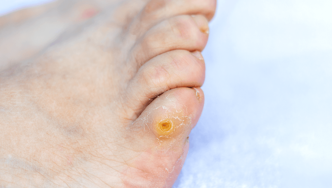 Are Verrucas Contagious? Causes, Symptoms and Treatments