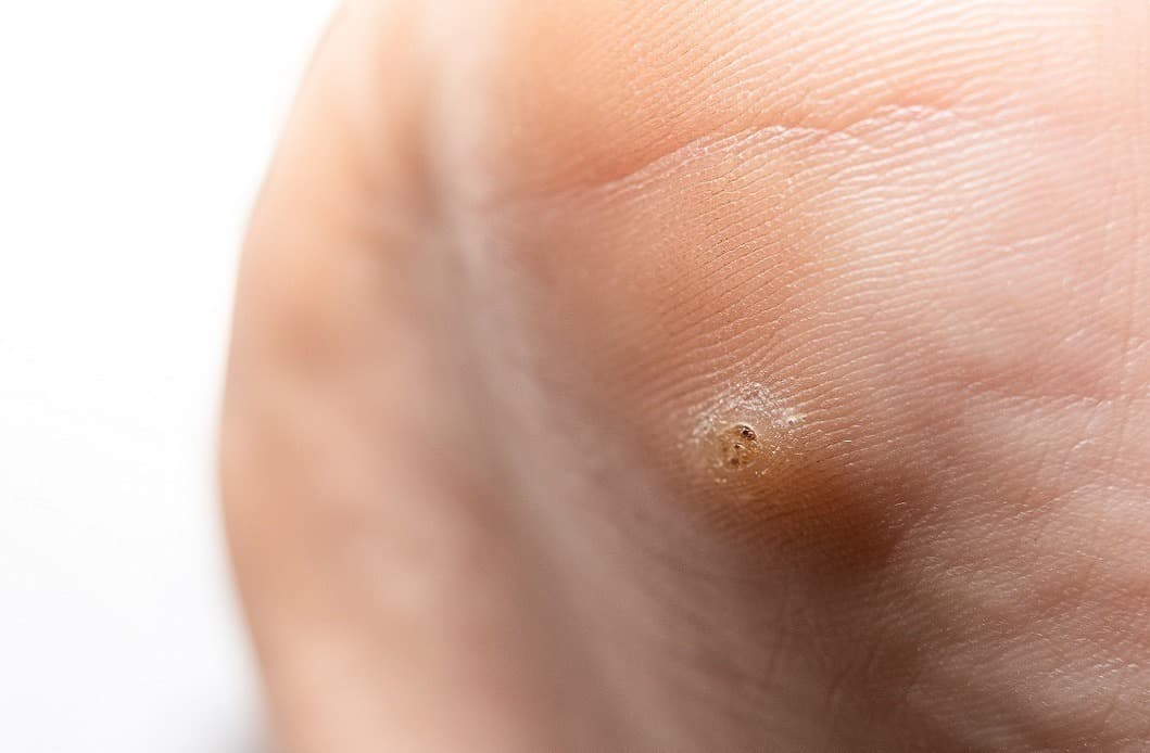 How To Get Rid Of Warts? Professional & At-Home Methods Explained