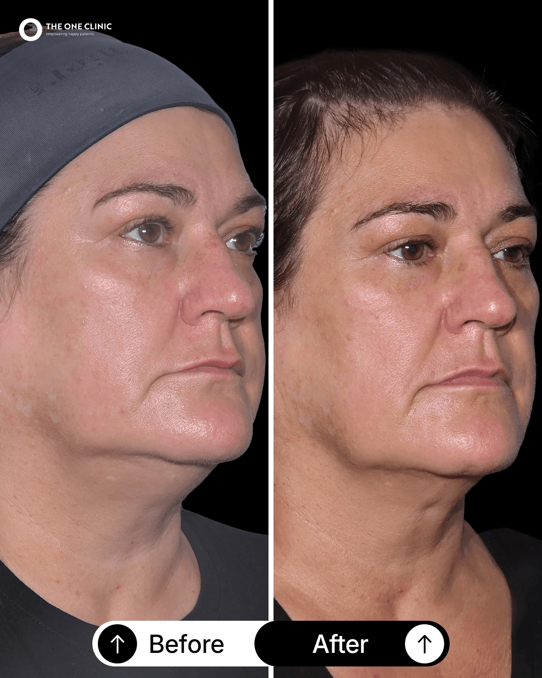 Patient before and after results