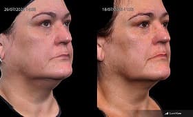 Endolift before and after result 1