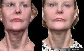 Endolift before and after result 2