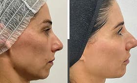 Endolift before and after result 3