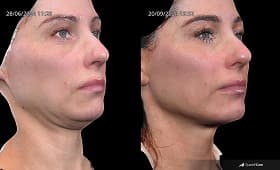 Endolift before and after result 5
