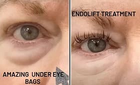 Endolift before and after result 6
