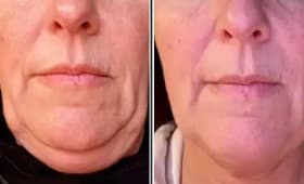 Exosome therapy skin rejuvenation result 7