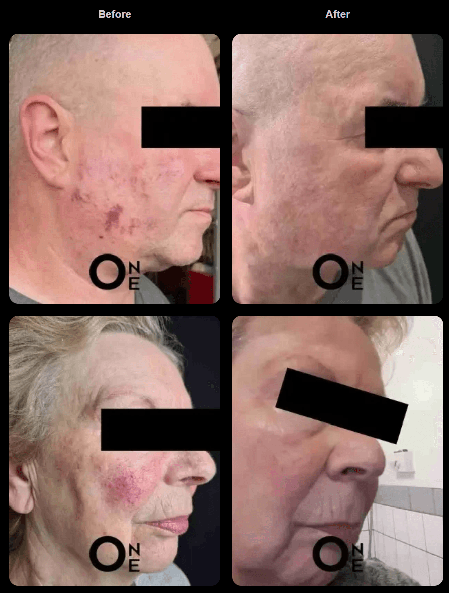 Before and after treatment result 1