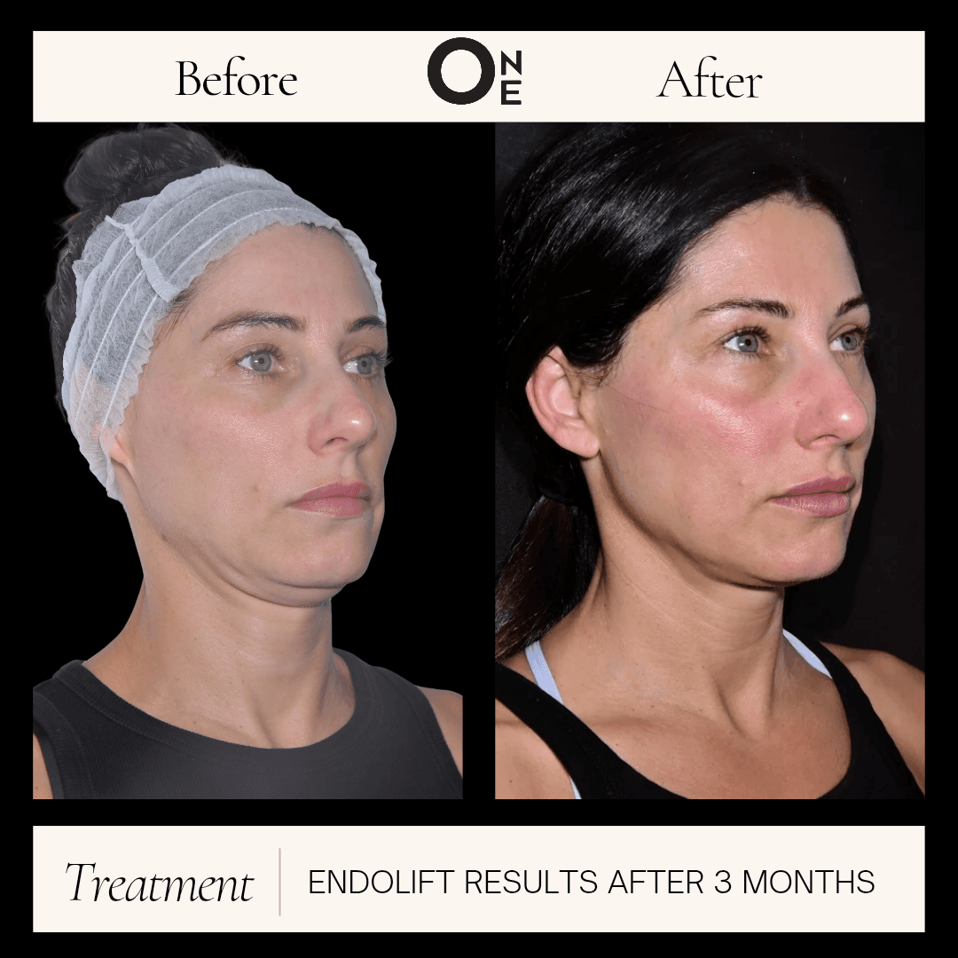 Before and after treatment result 2