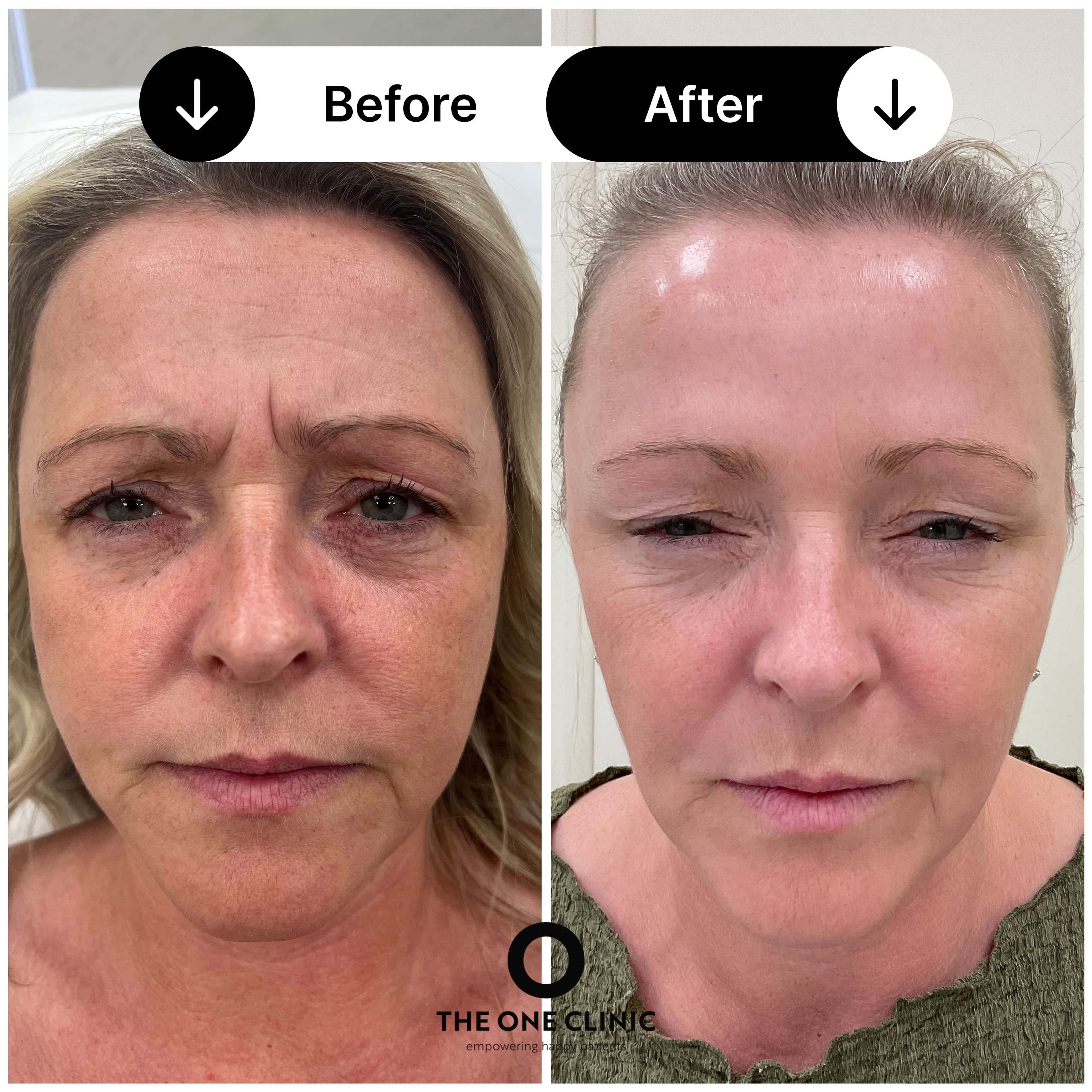 Anti-wrinkle injections before and after results