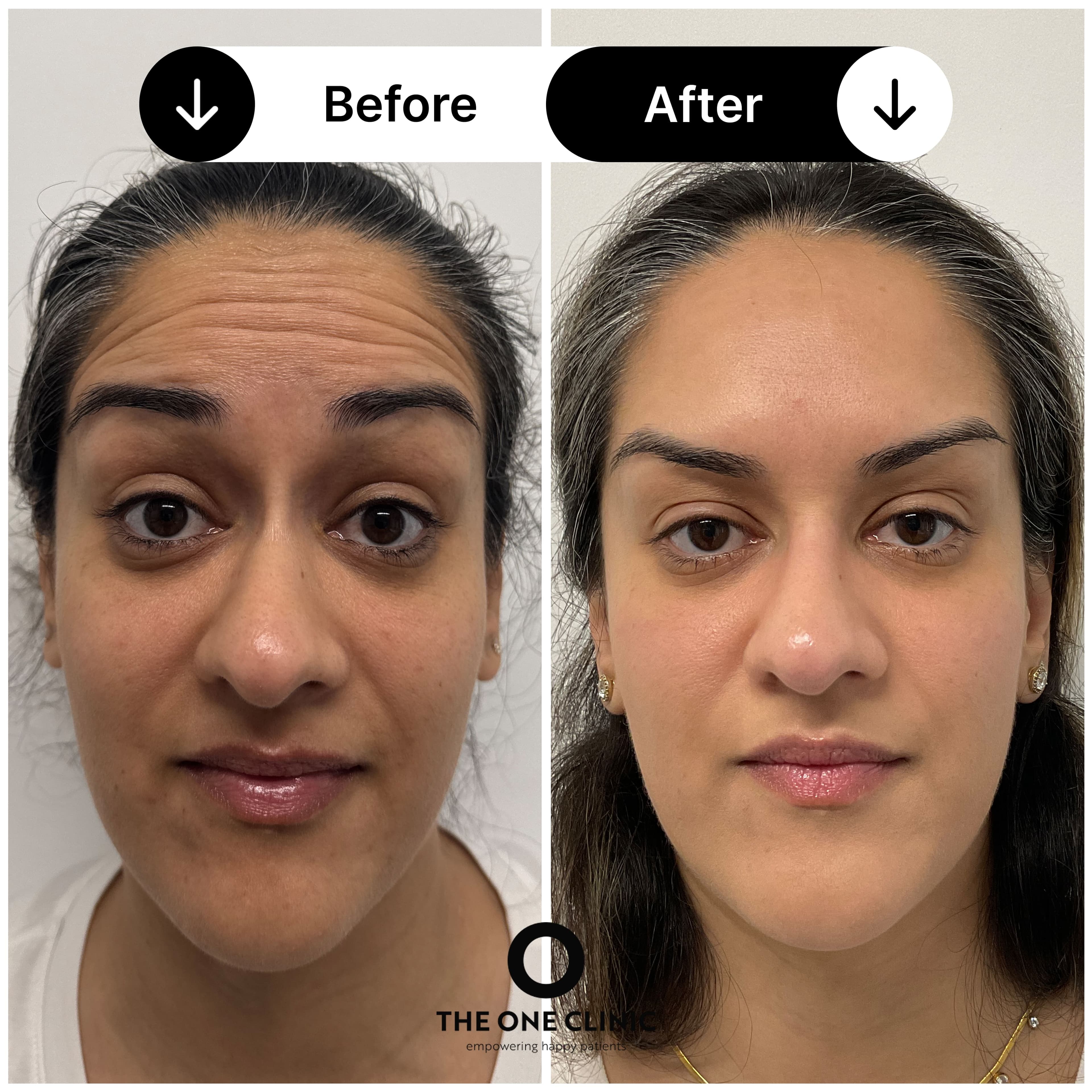 Anti-wrinkle injections before and after results