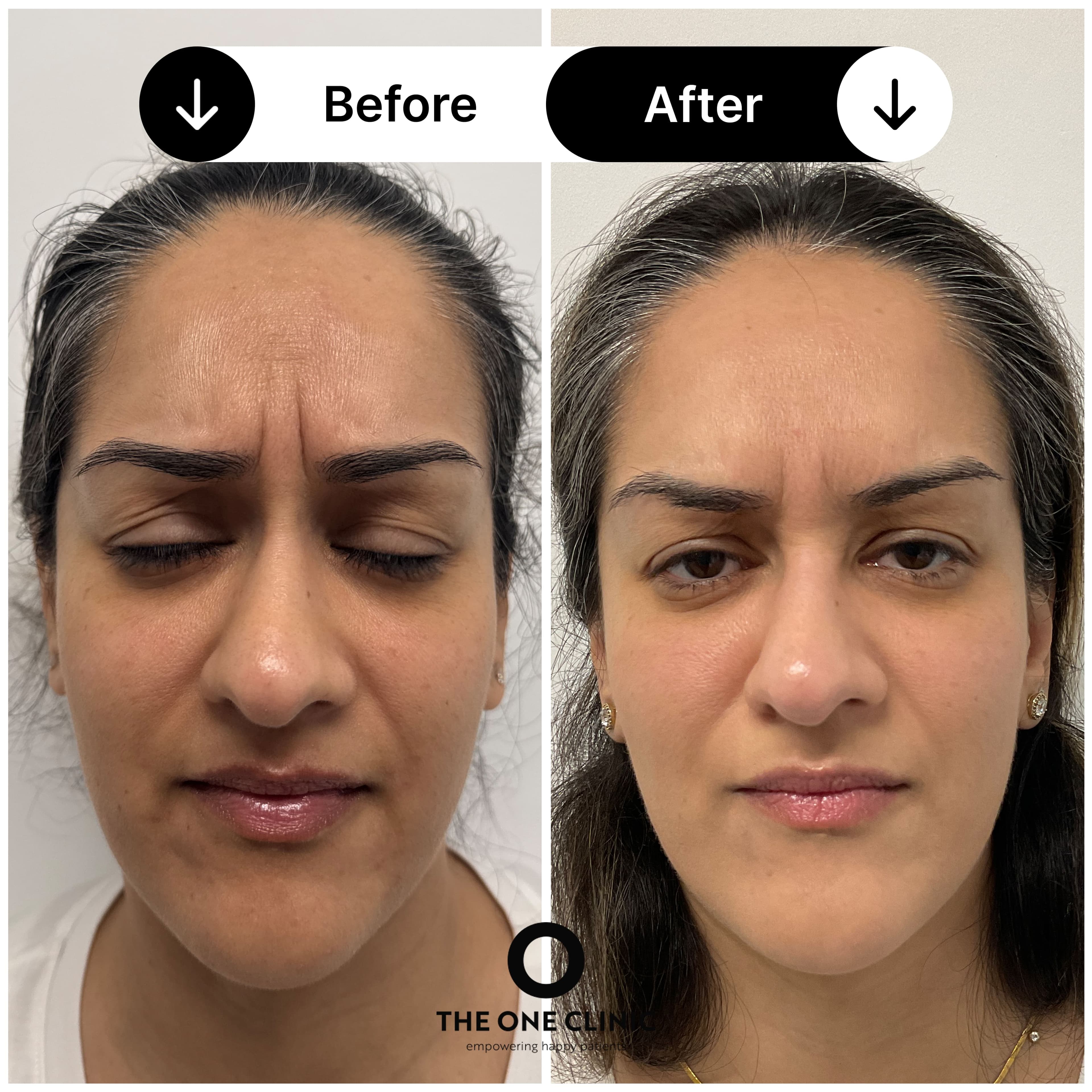 Anti-wrinkle injections before and after results