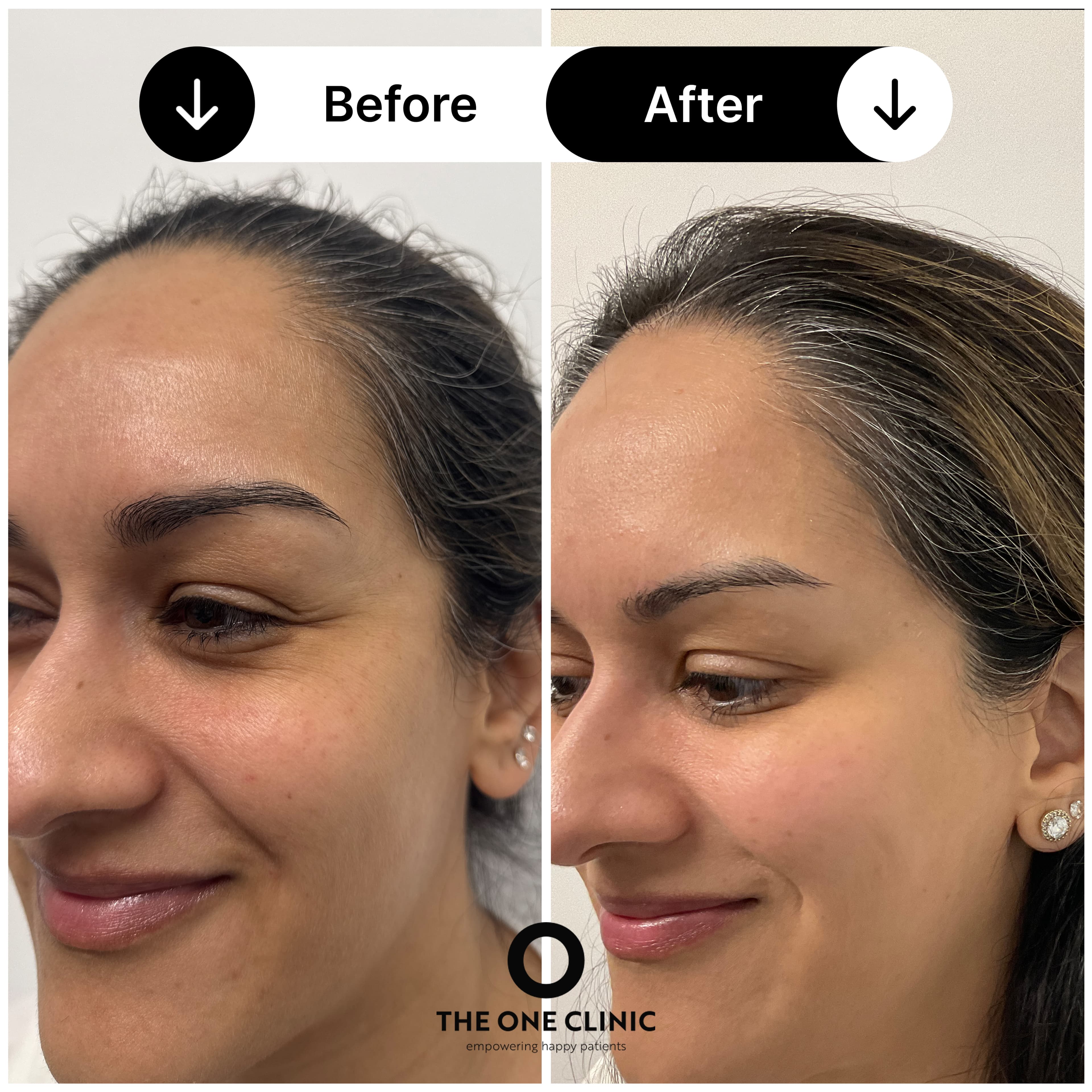 Anti-wrinkle injections before and after results