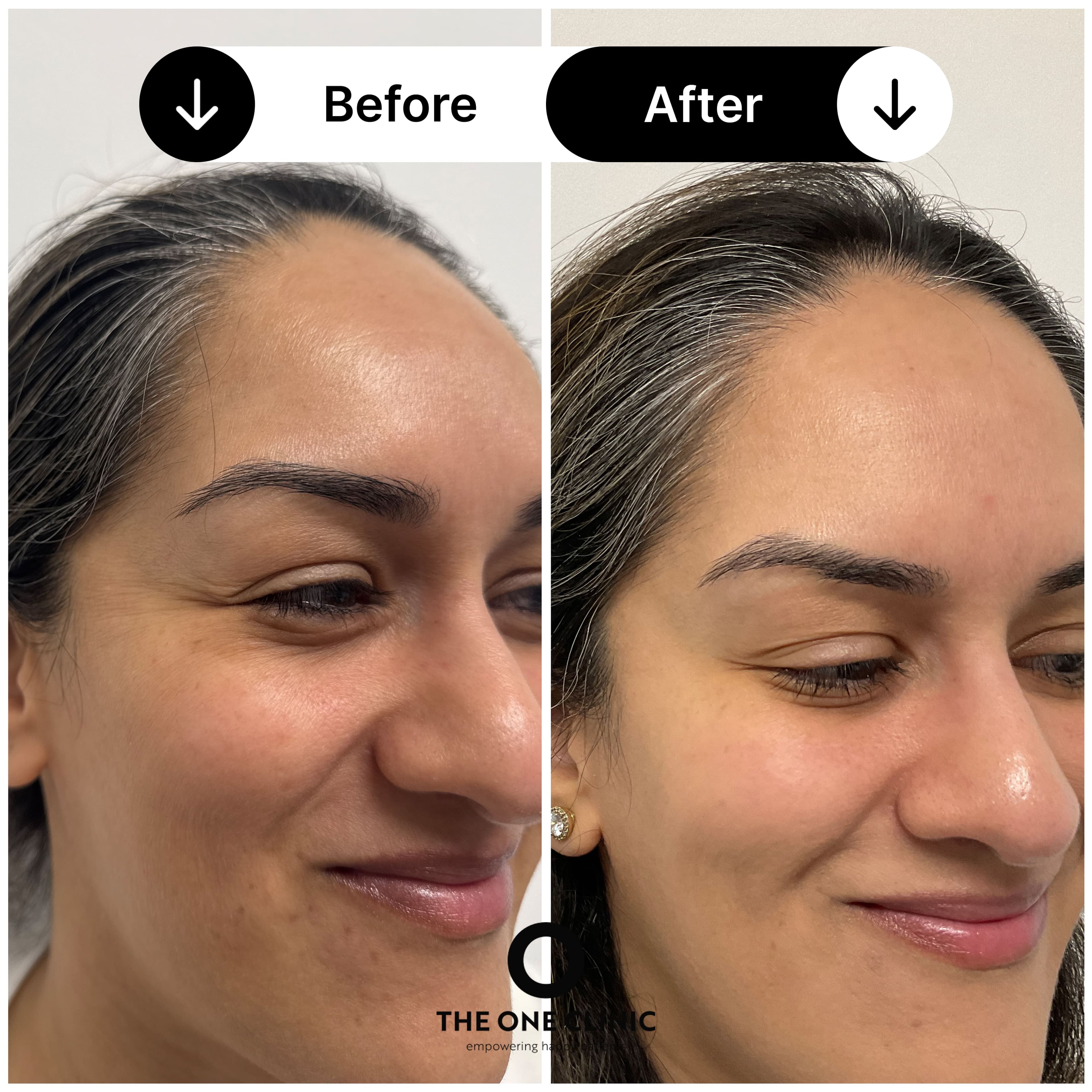 Anti-wrinkle injections before and after results