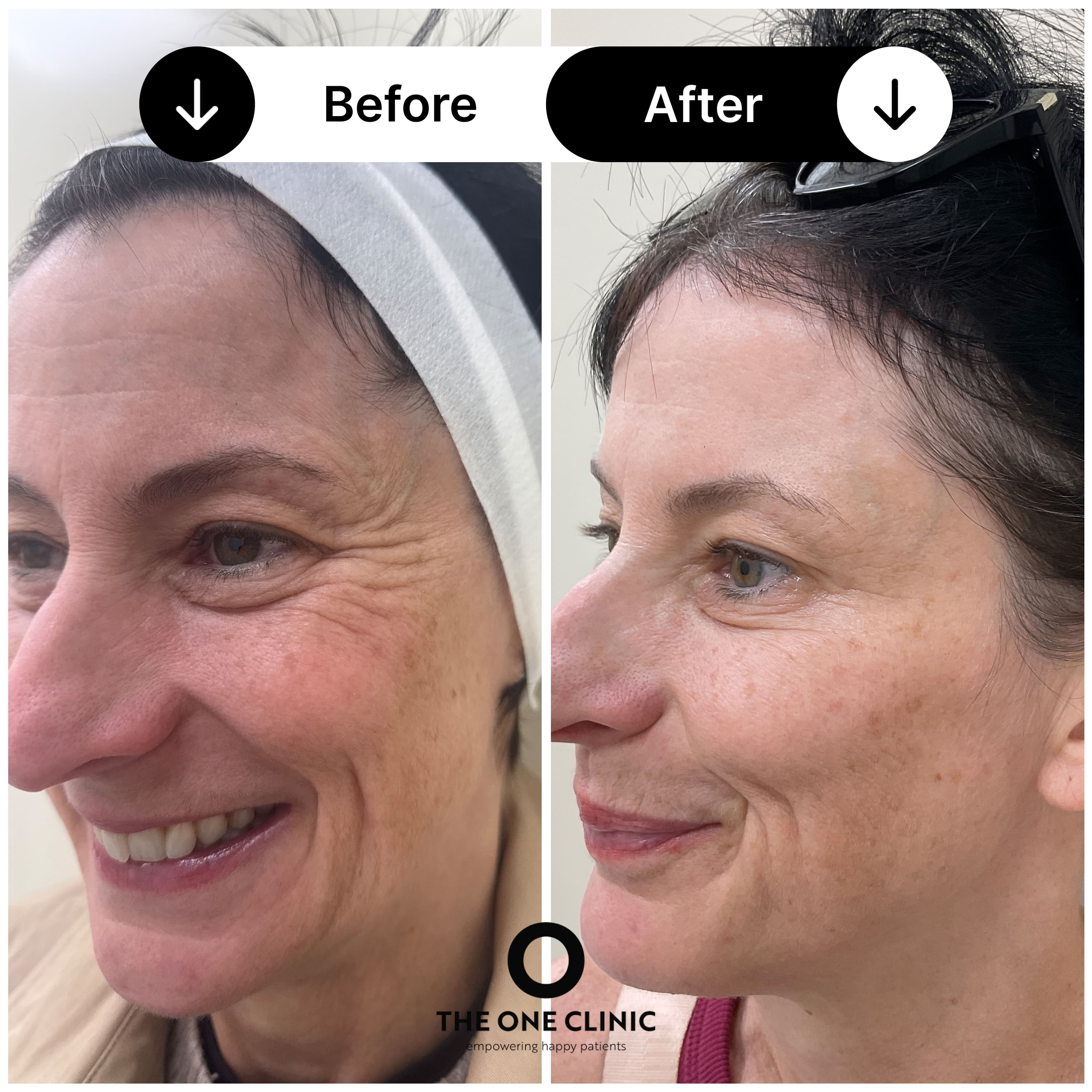 Anti-wrinkle injections before and after results