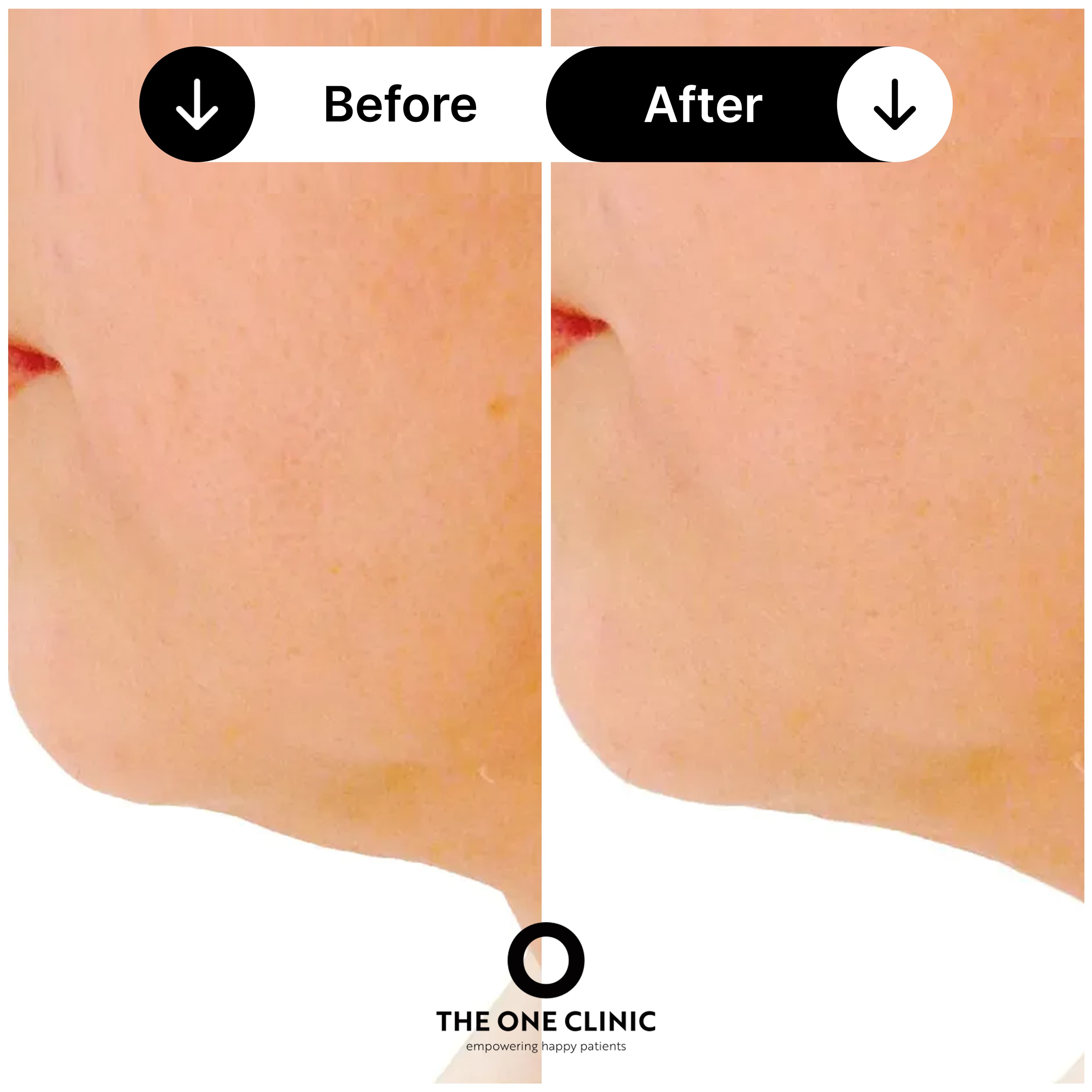 Endolift before and after result 2