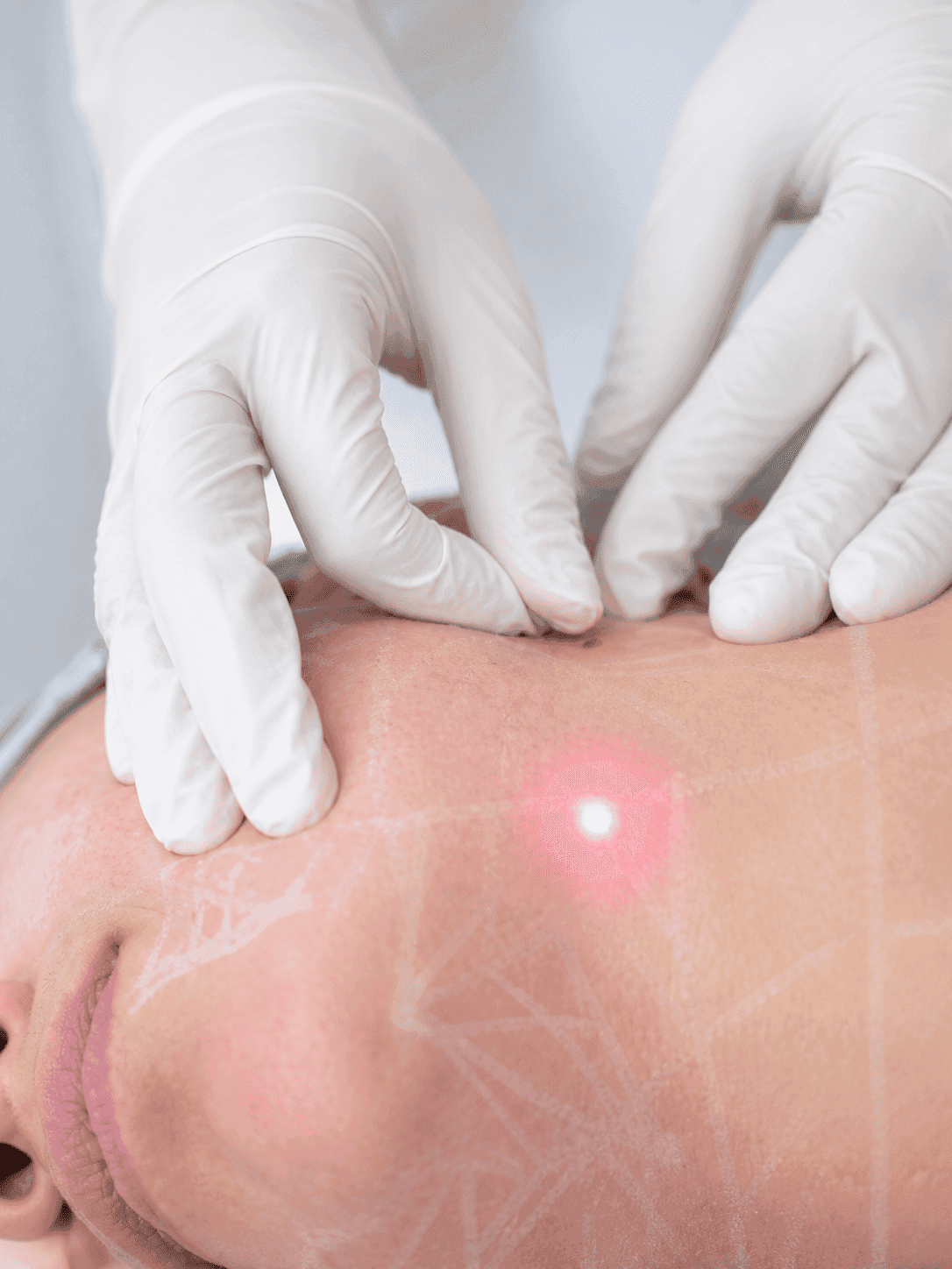 What is Endolift treatment results at The One Clinic