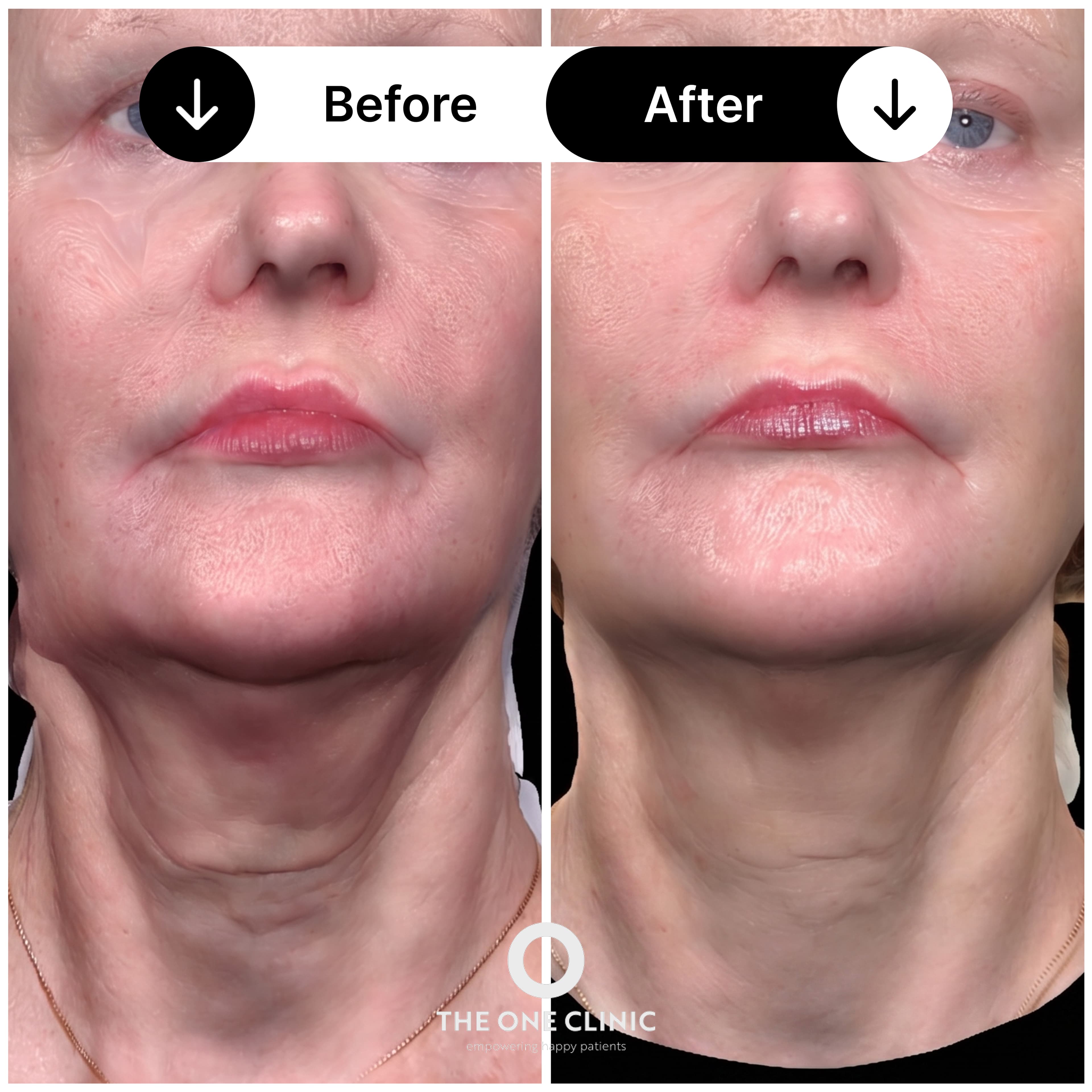 Endolift before and after result 3