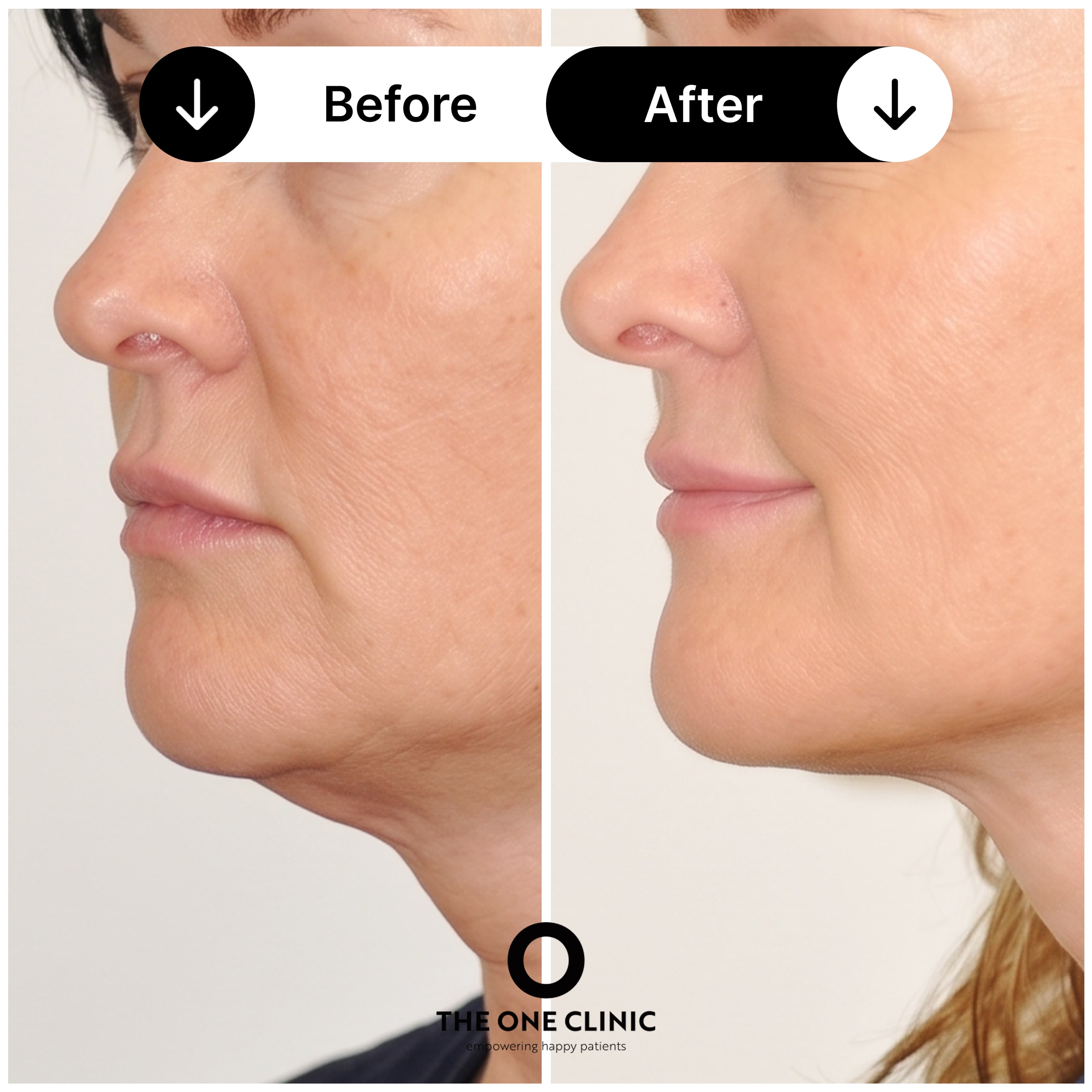 Endolift before and after result 5