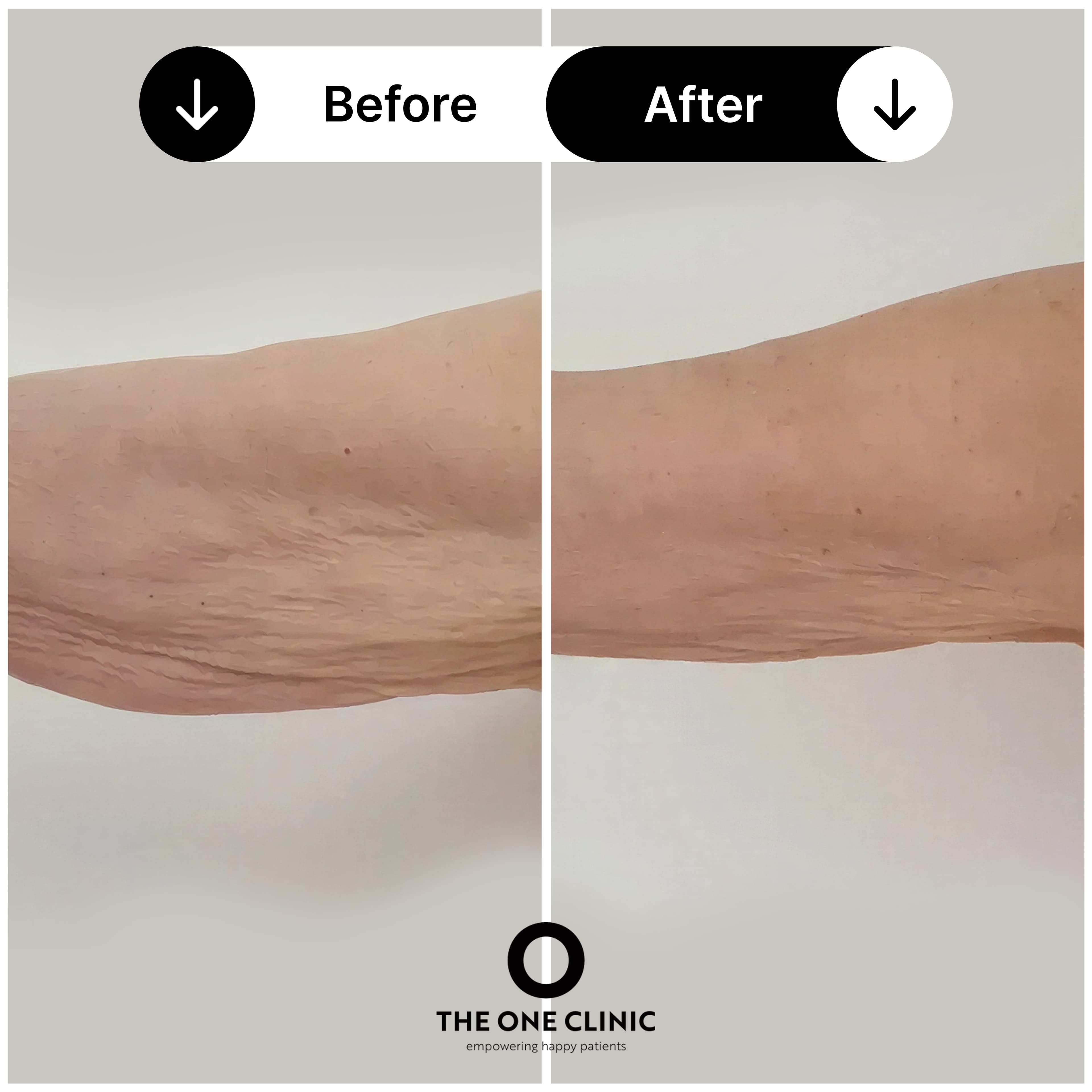 Endolift before and after results