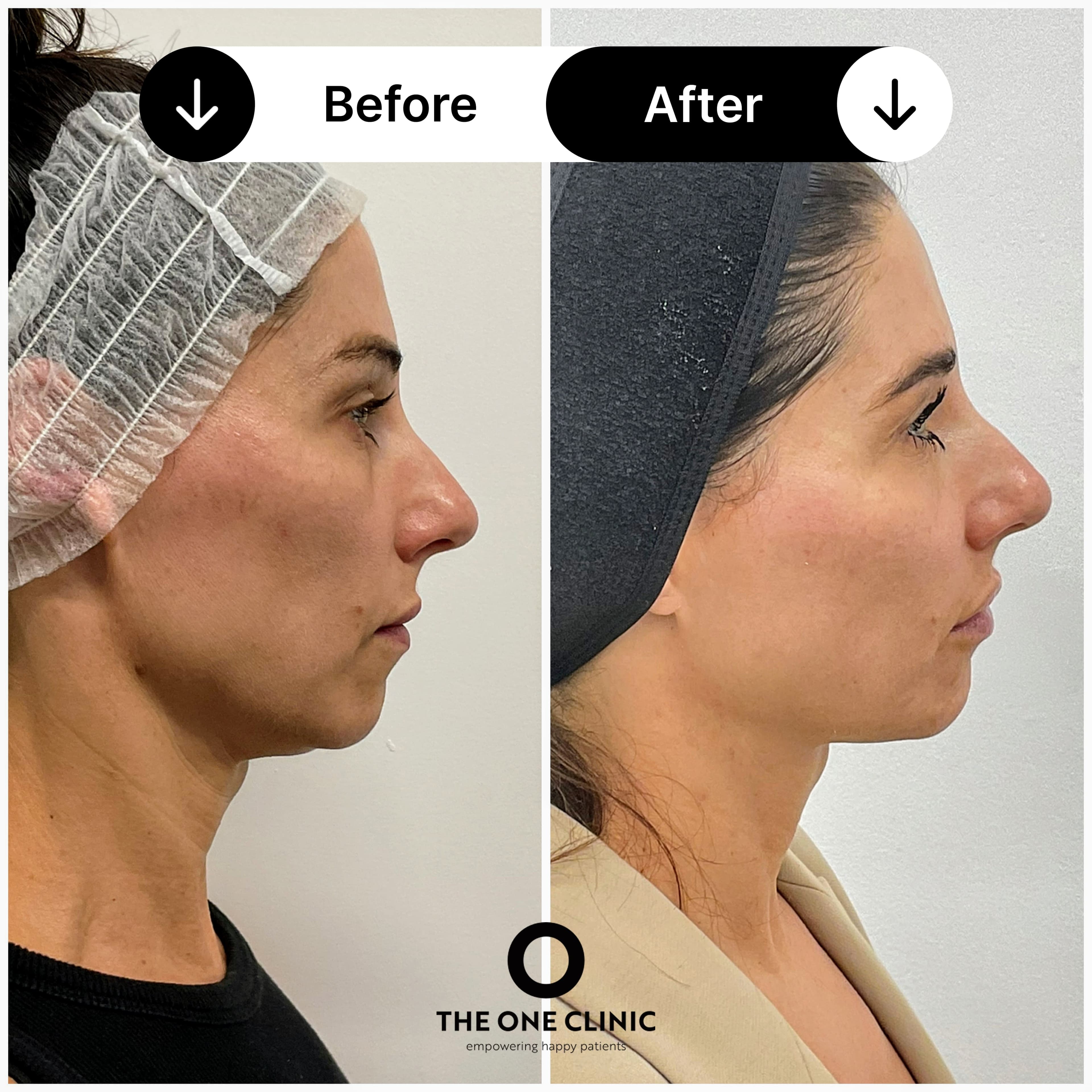 Endolift before and after result