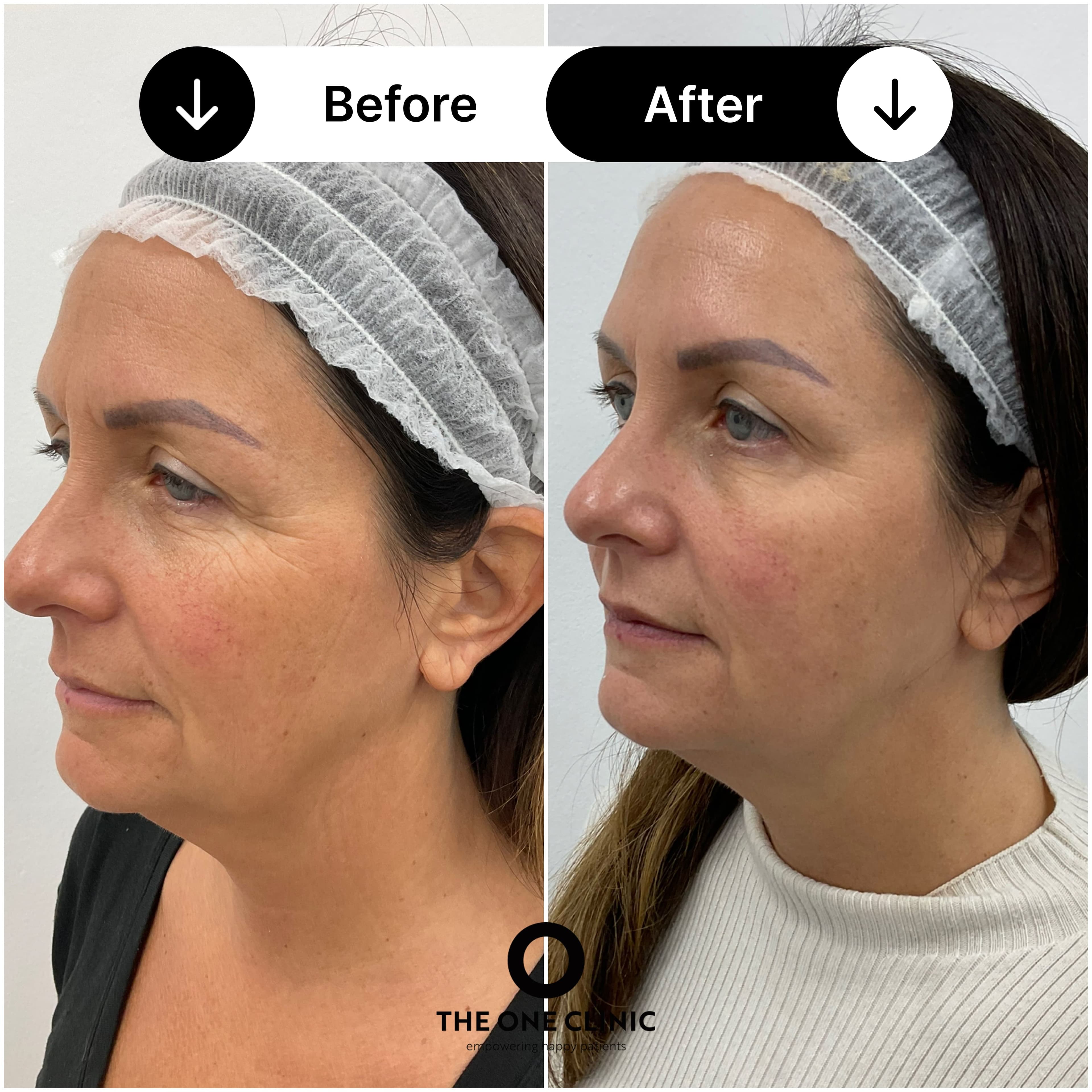 Endolift before and after result