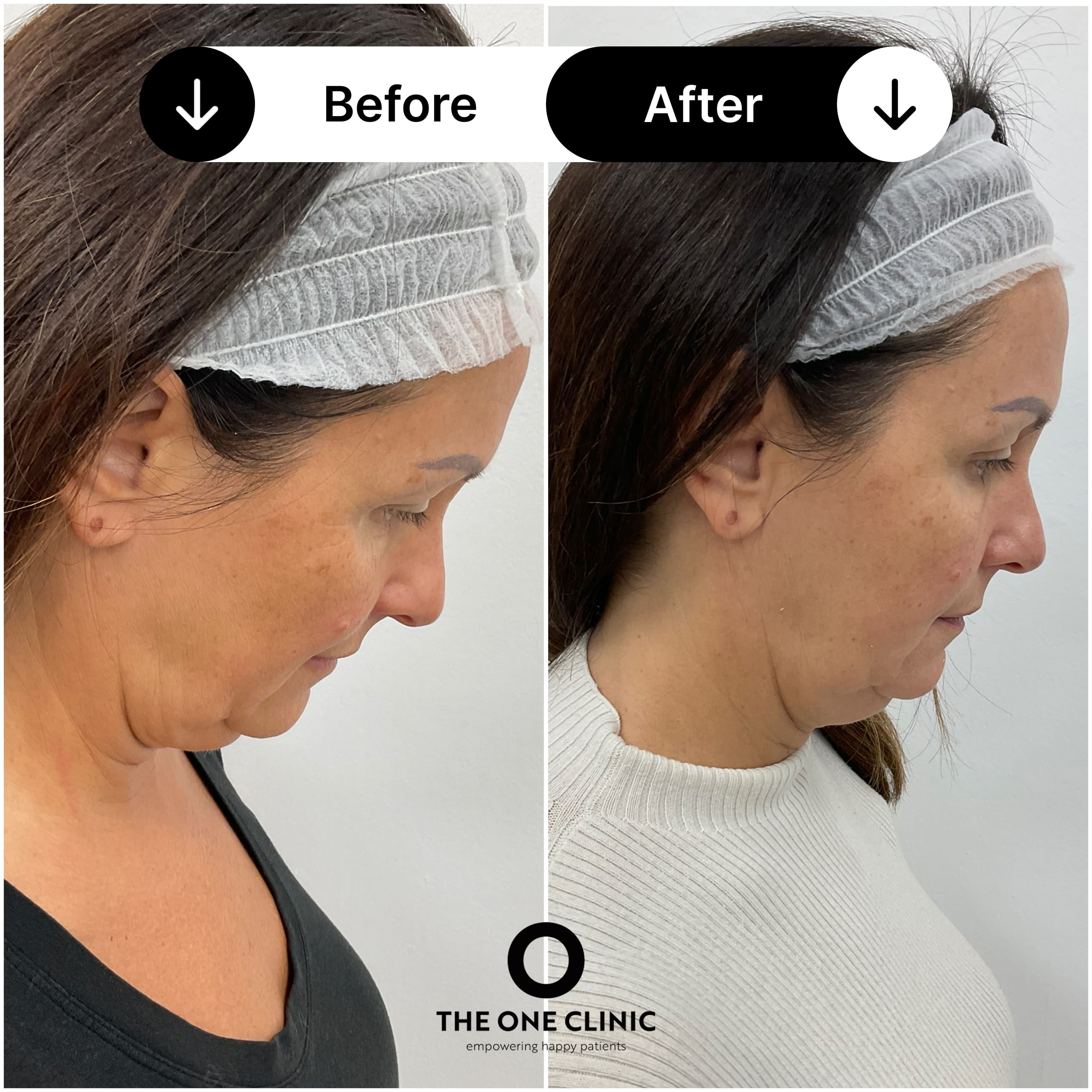 Endolift before and after result