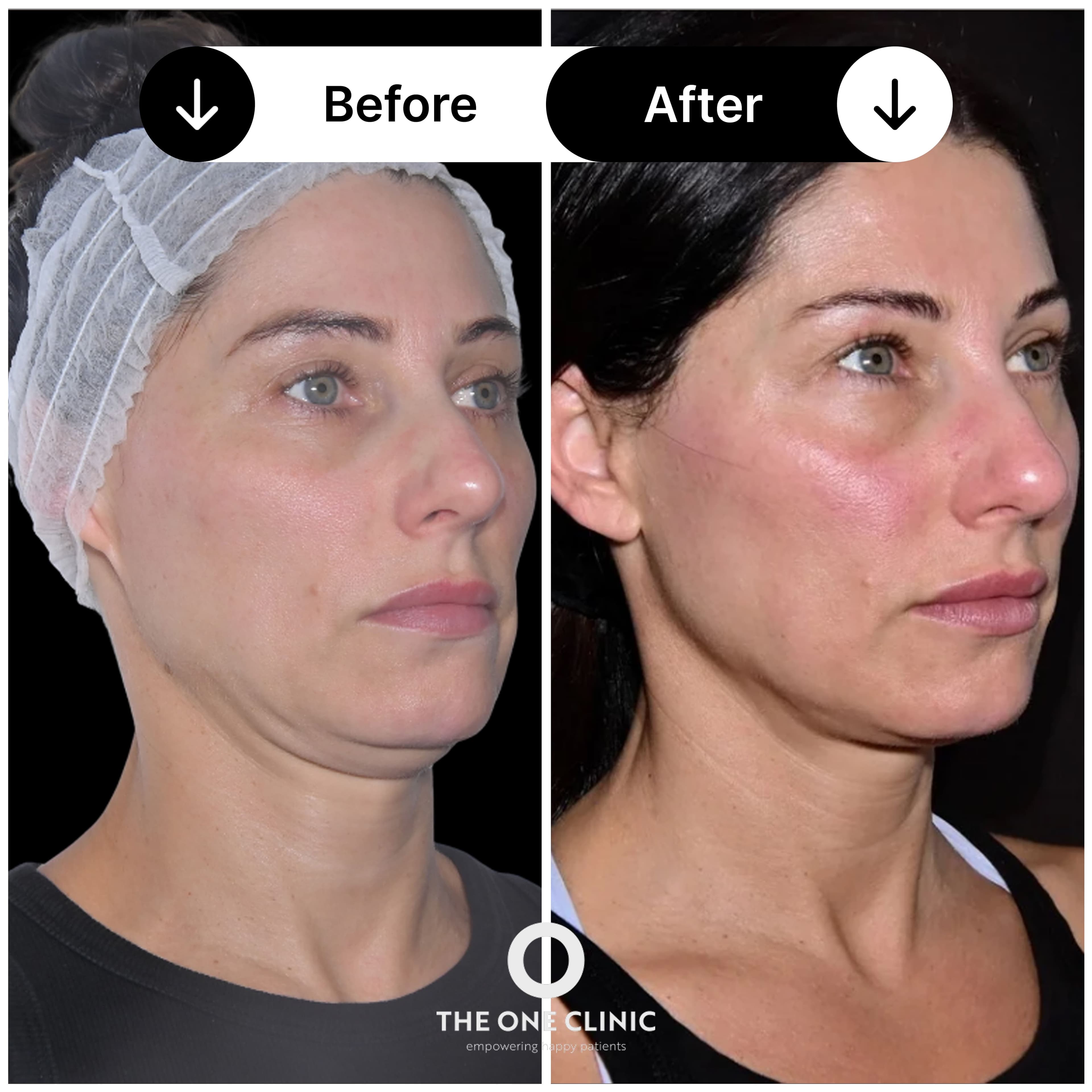 Endolift before and after result