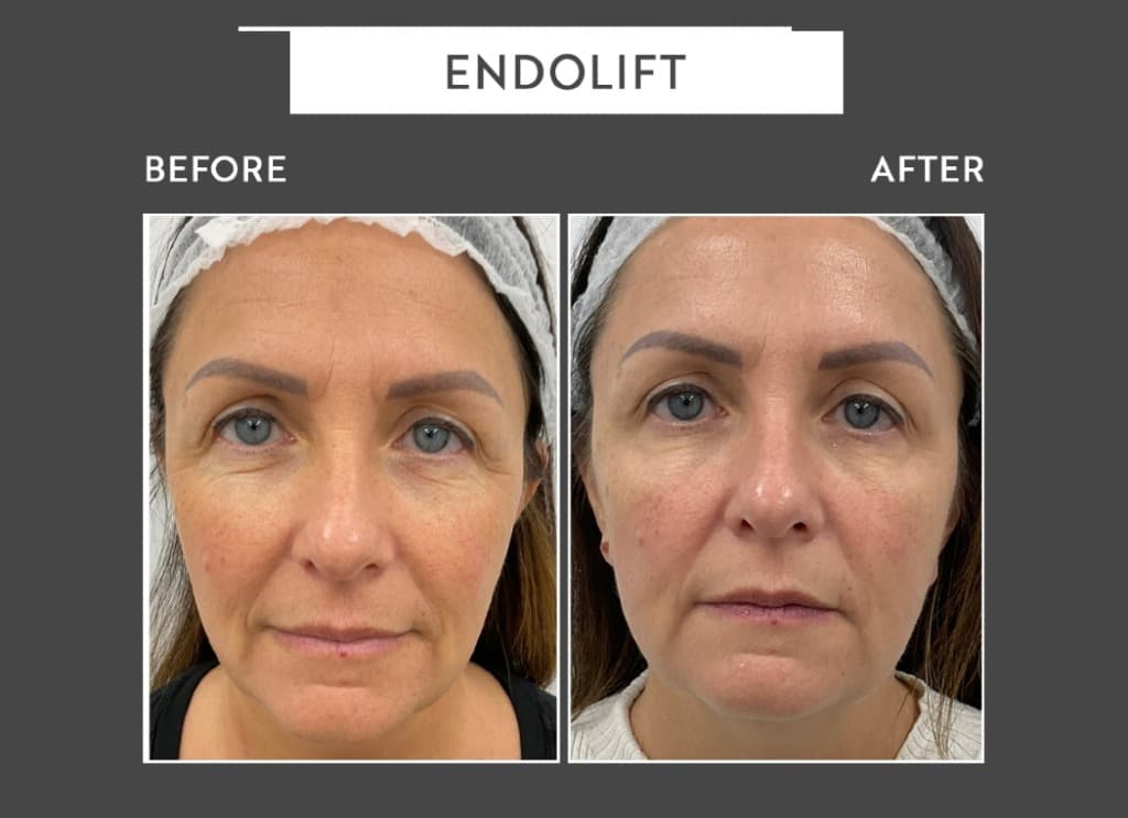 Endolift Before and After: Real Results, Photos & What to Expect