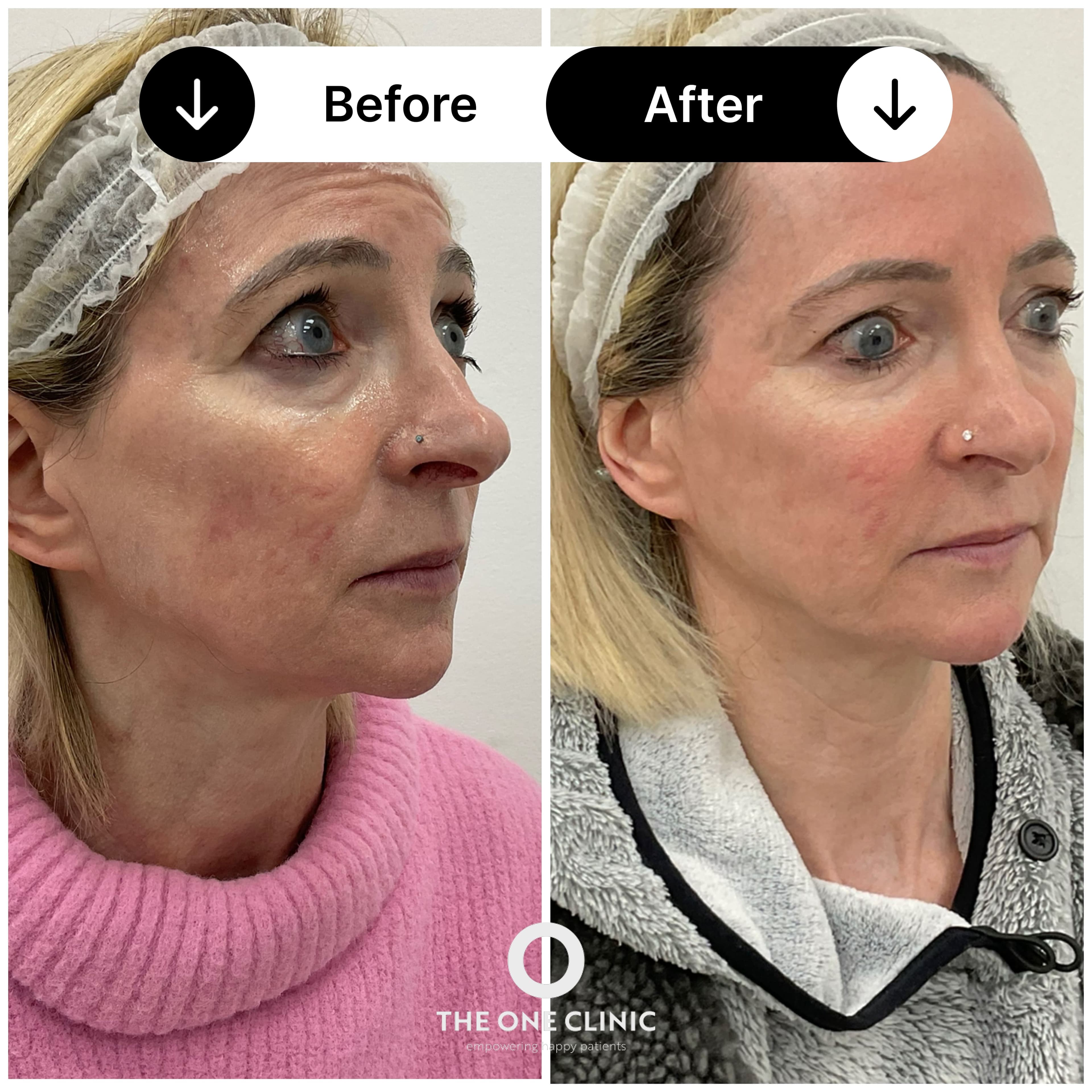 Filler before and after results