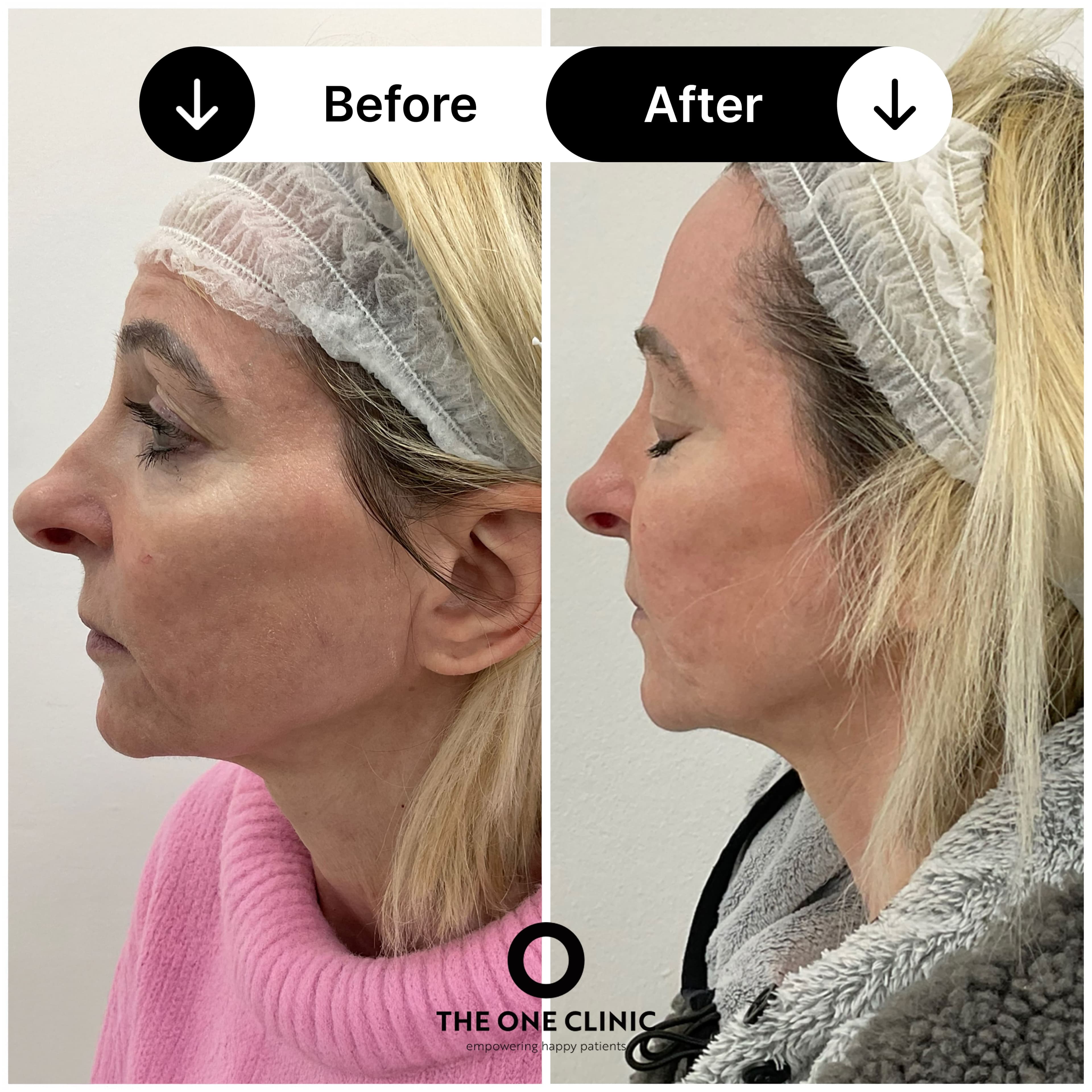 Filler before and after results