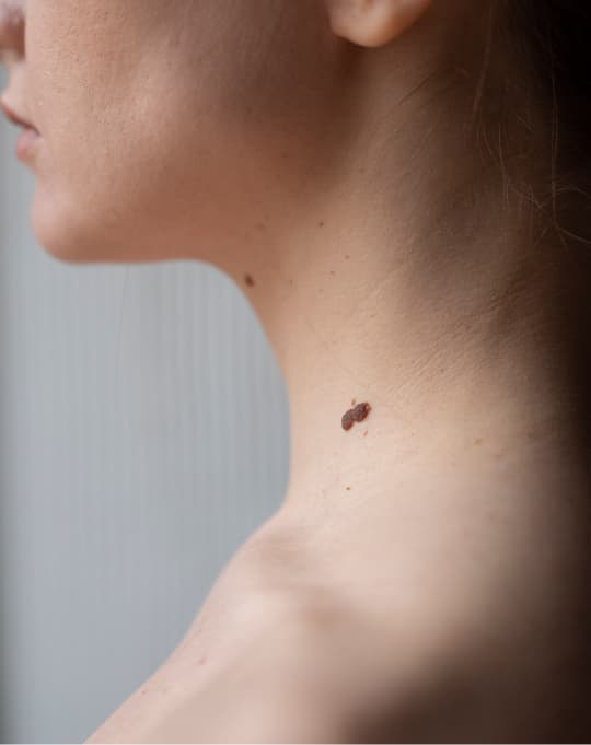 Mole removal at The One Clinic Leicester