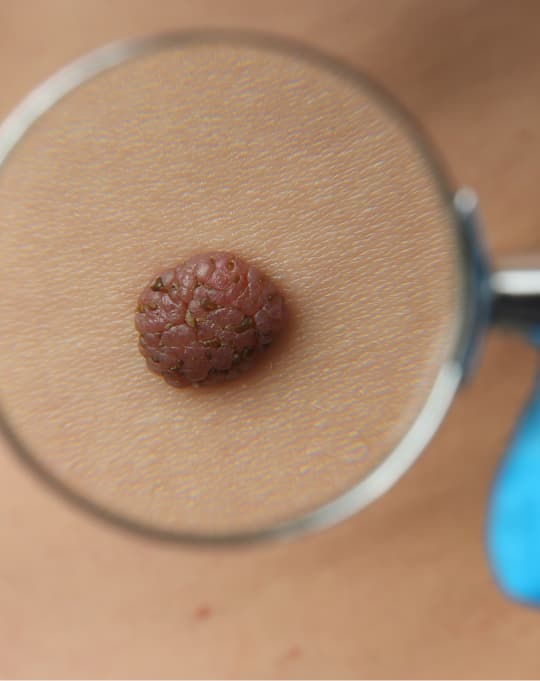 Skin lesion removal procedure at The One Clinic Leicester