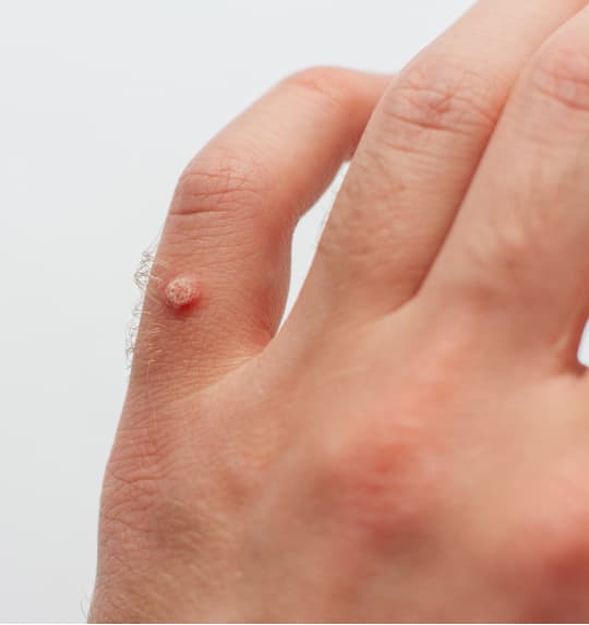 Wart removal treatment at The One Clinic Leicester