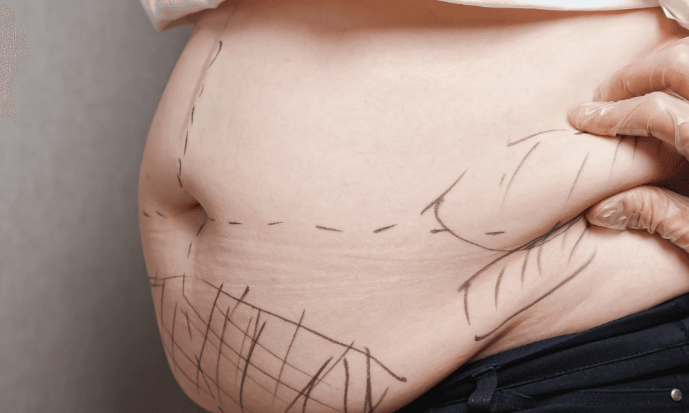 How Much Is Liposuction