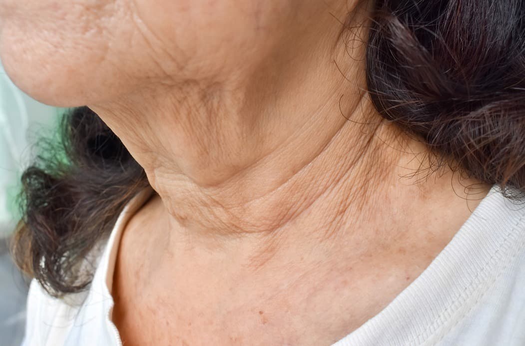How To Get Rid Of Saggy Neck? A Guide To Firm Neck Skin