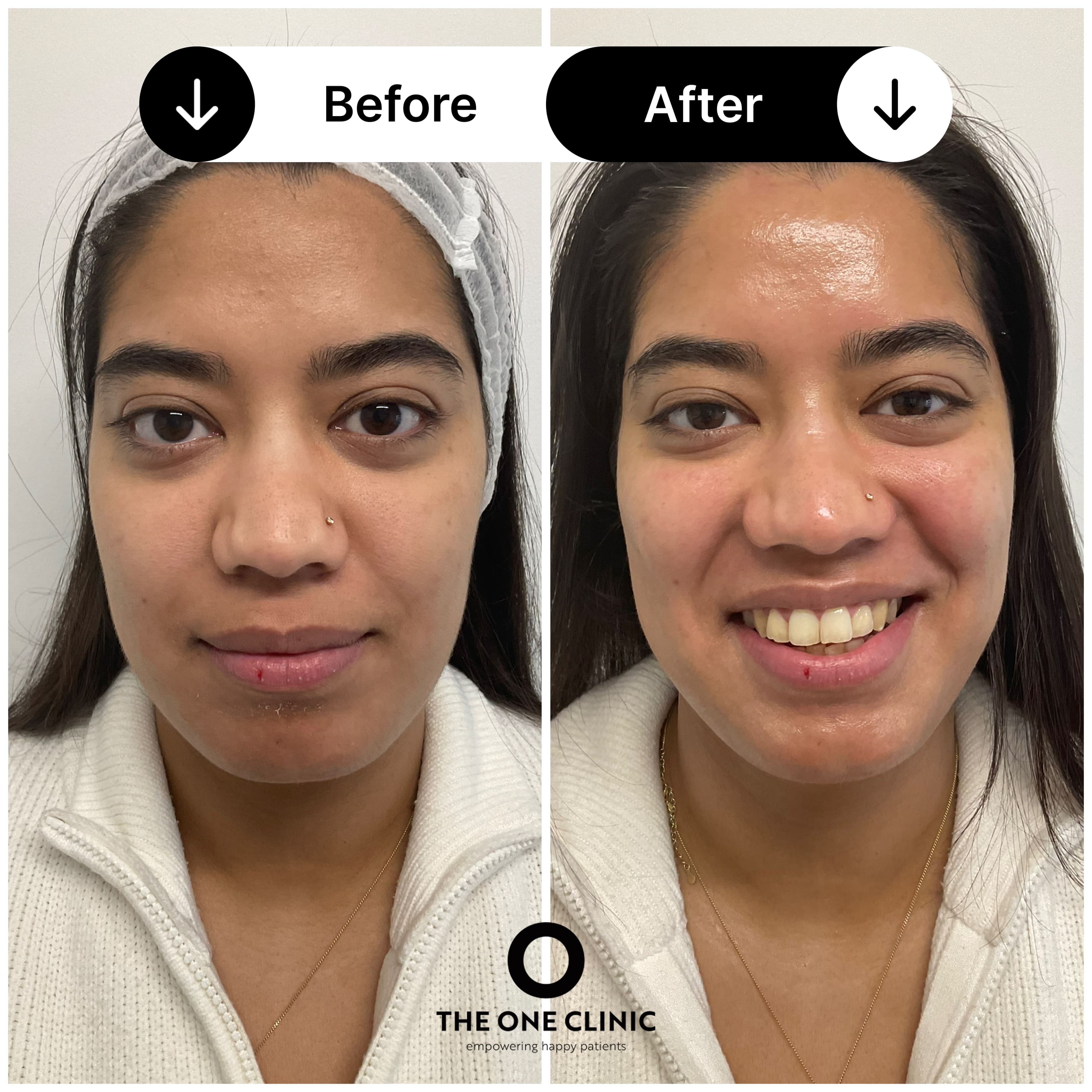 Hydrafacial before and after results