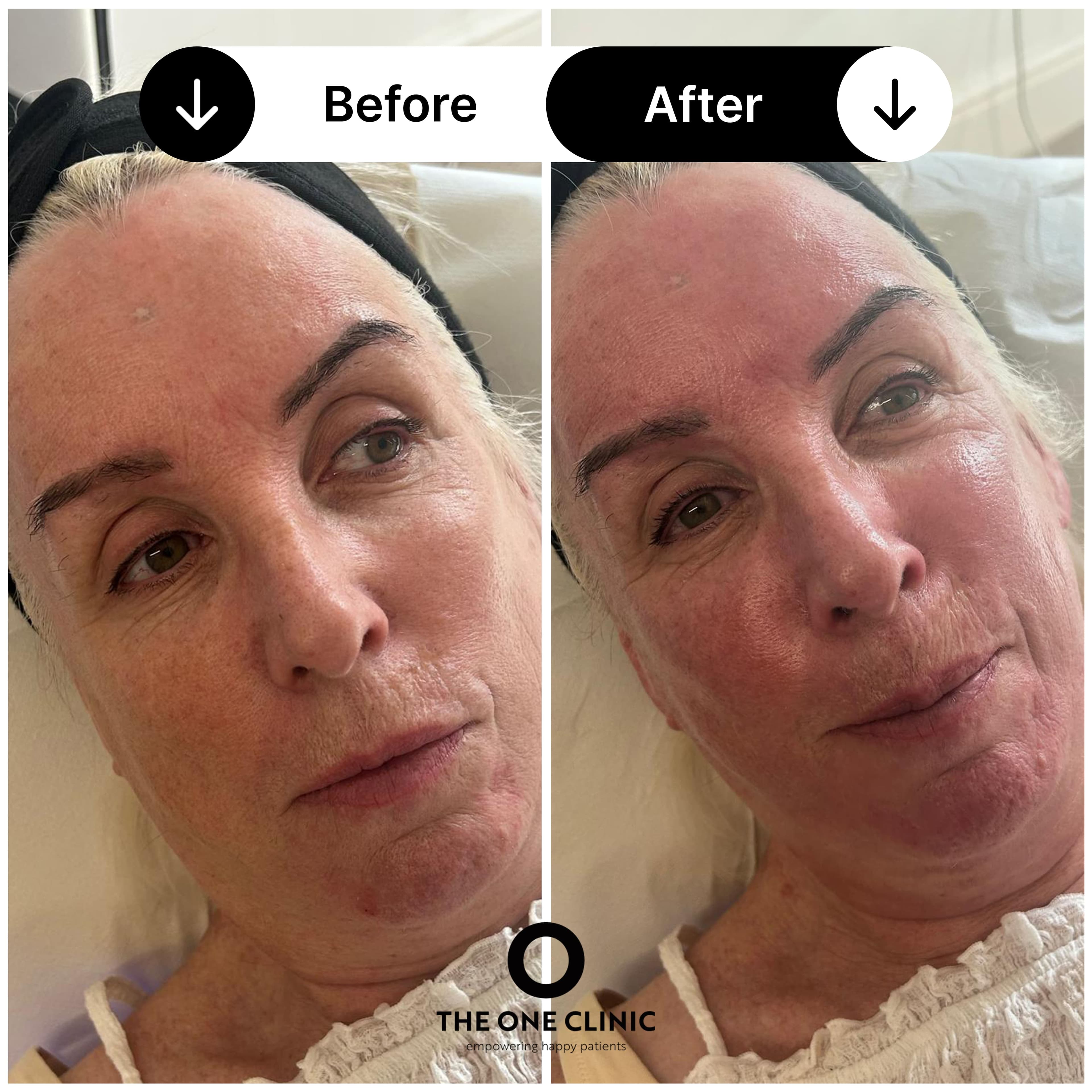 Hydrafacial before and after results