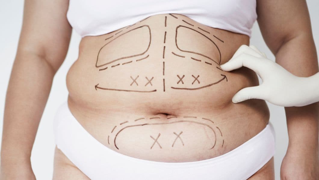 Is Liposuction Safe? Side Effects & Safety Precautions