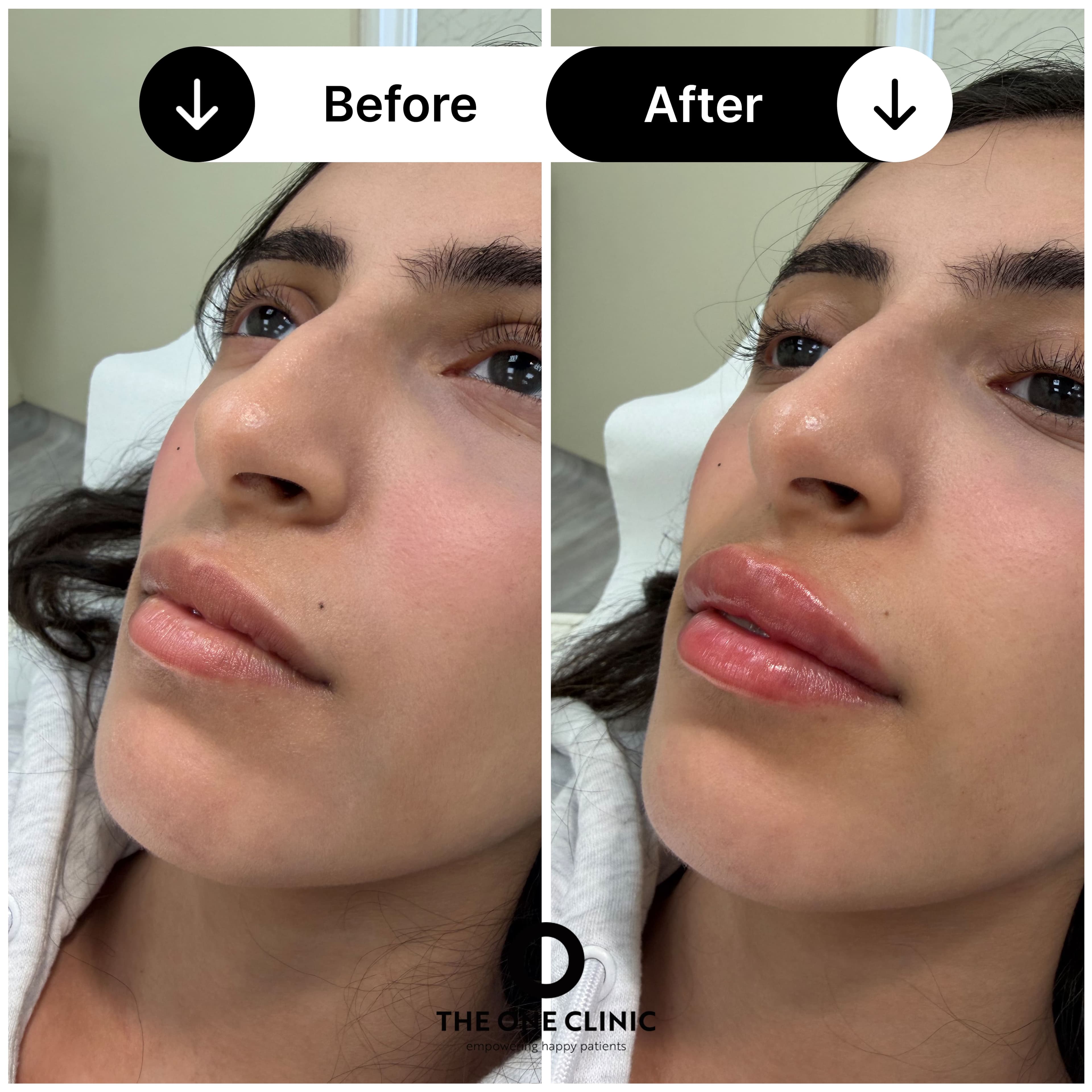 Lip filler before and after results