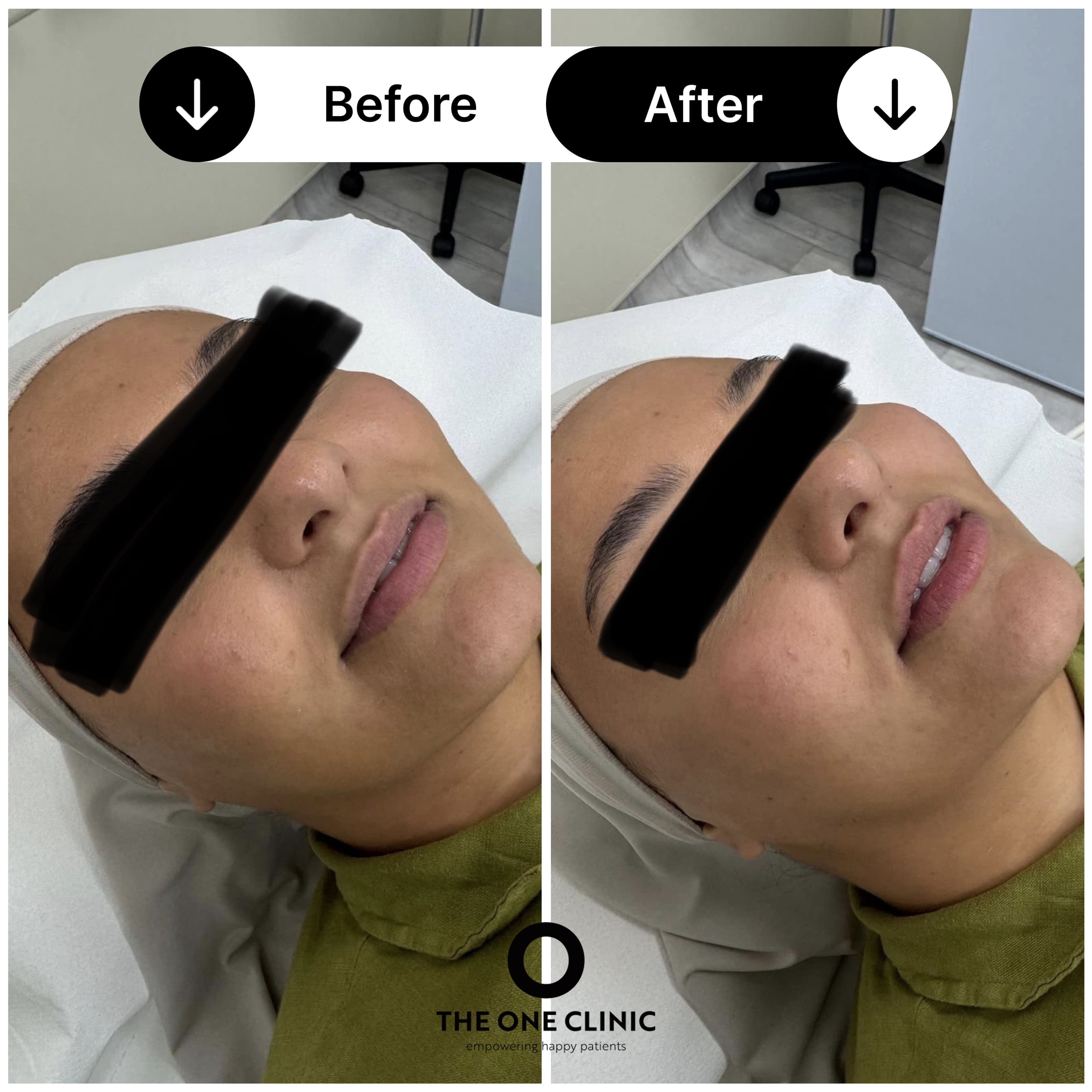 Lip filler before and after results