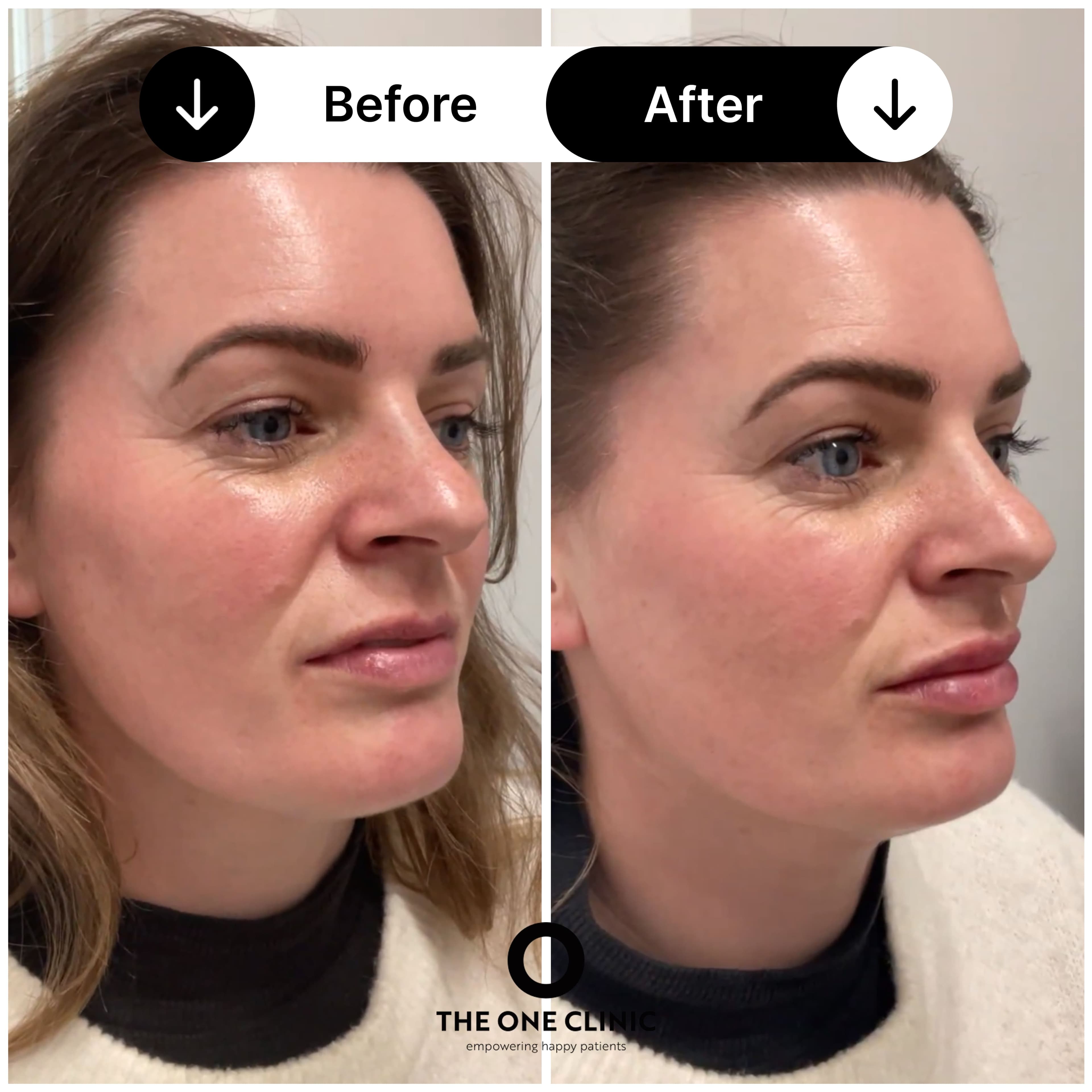 Lip filler before and after results