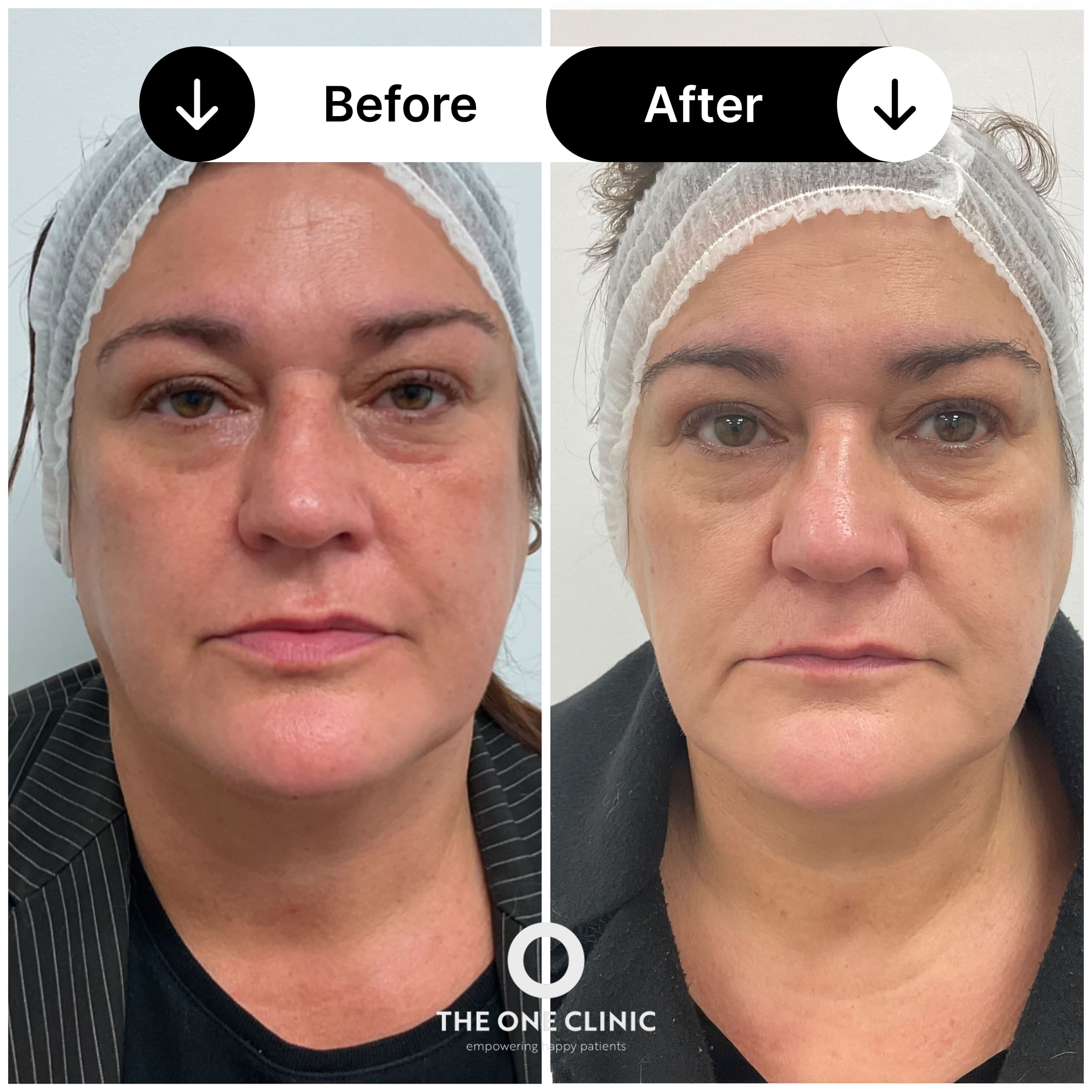 Lumecca laser before and after results