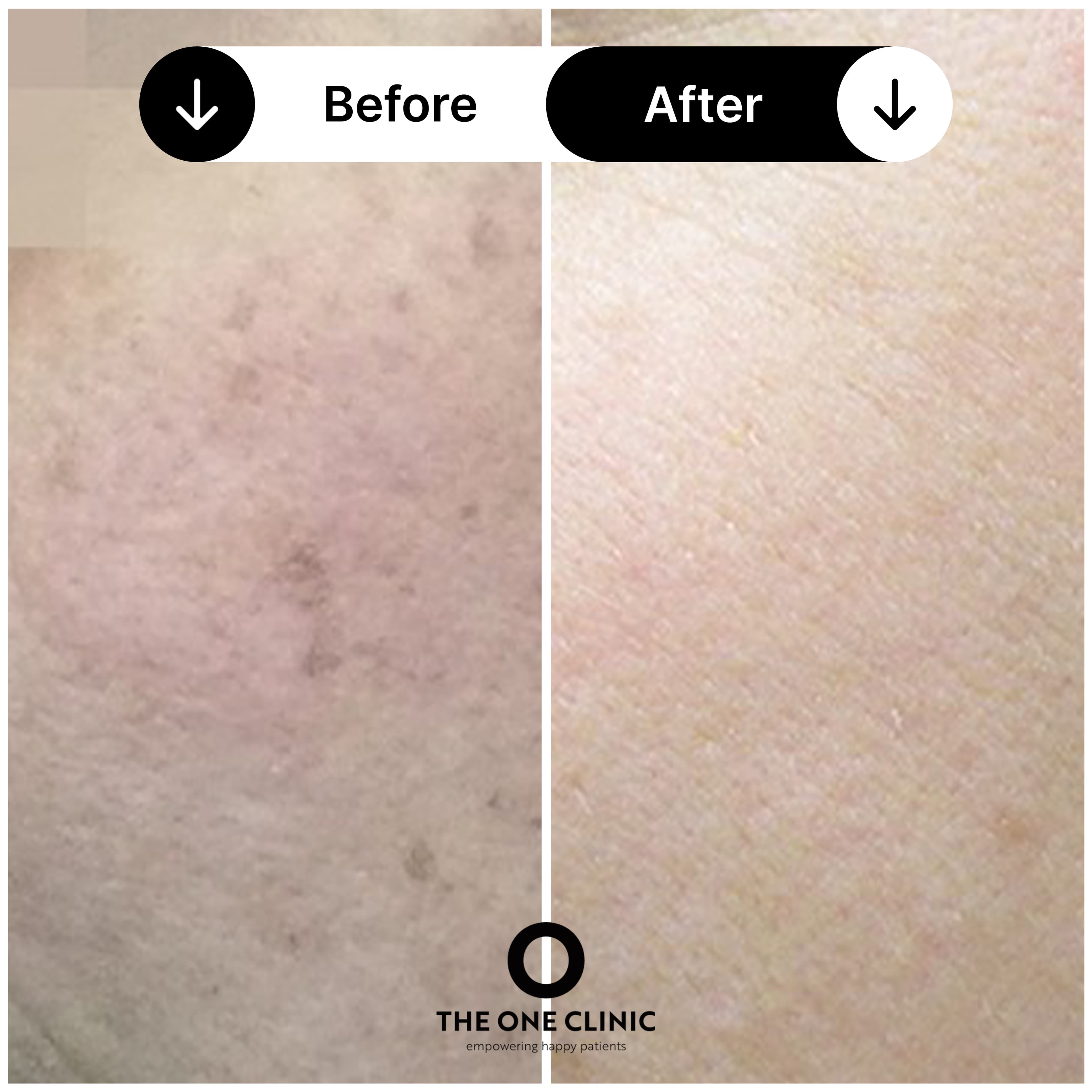 Lumecca IPL before and after results