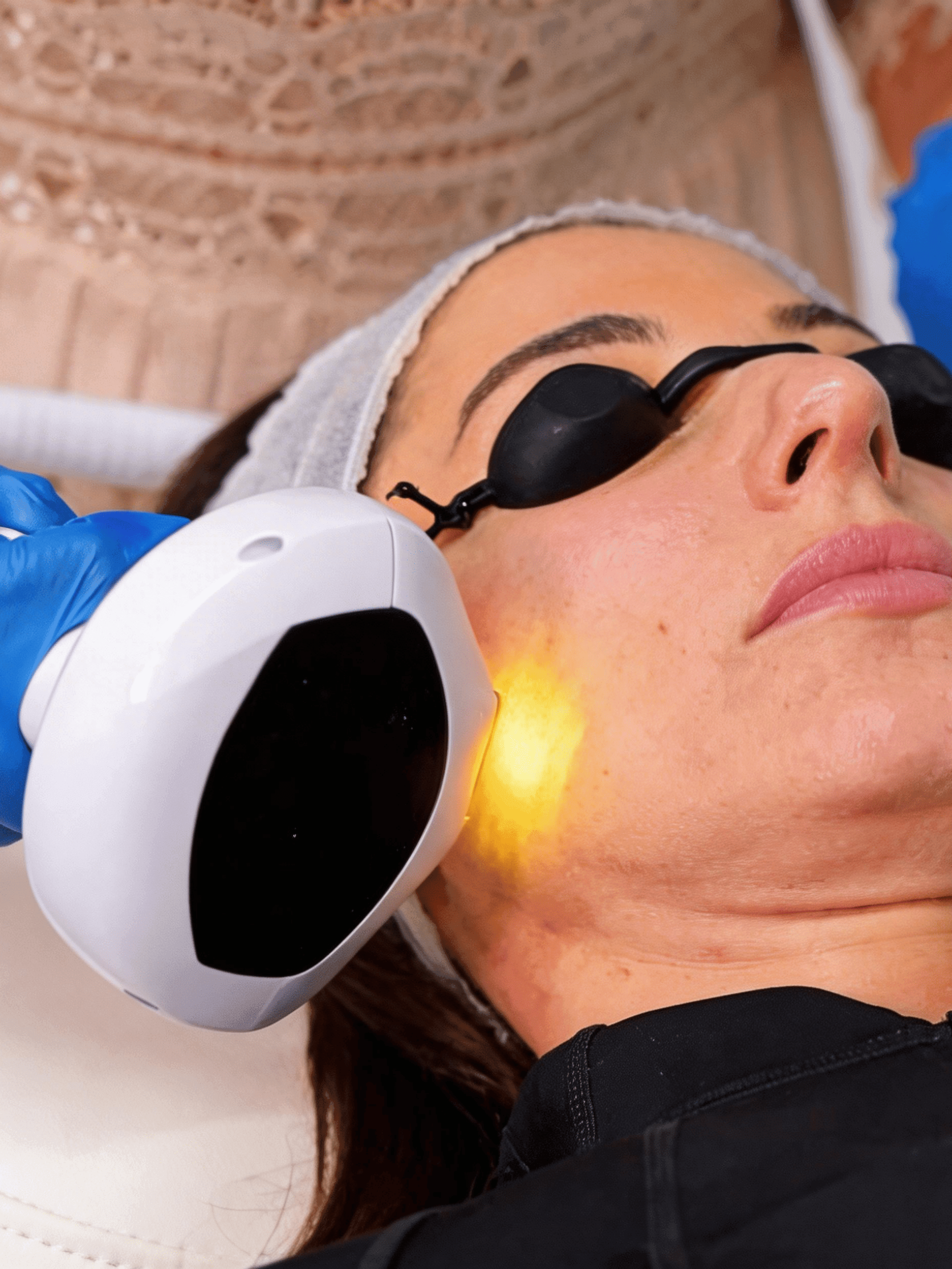 Lumecca IPL skin treatment at The One Clinic Leicester