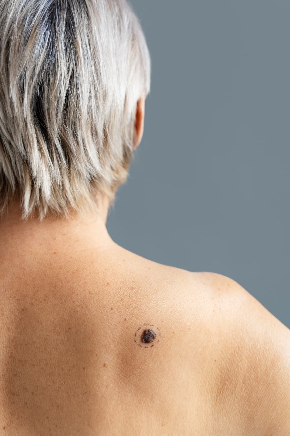 Laser mole removal consultation at The One Clinic