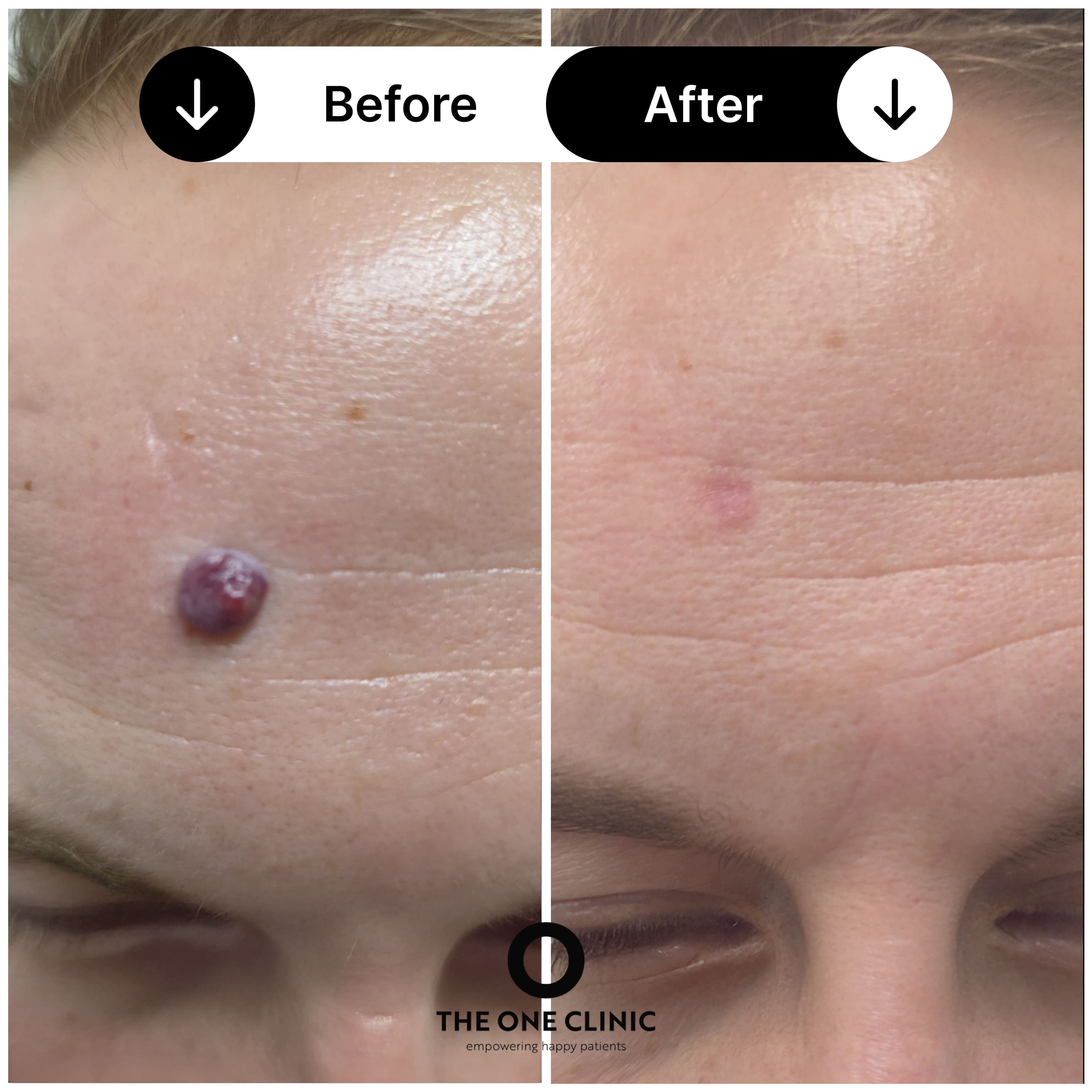 Mole removal before and after results
