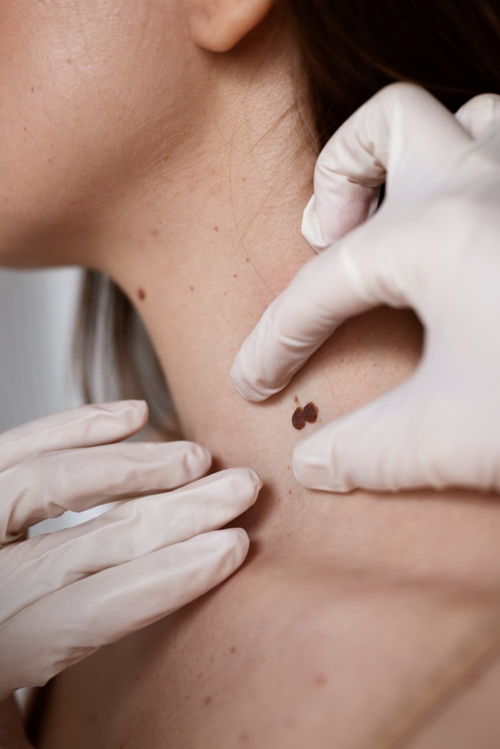 Laser mole removal at The One Clinic Leicester