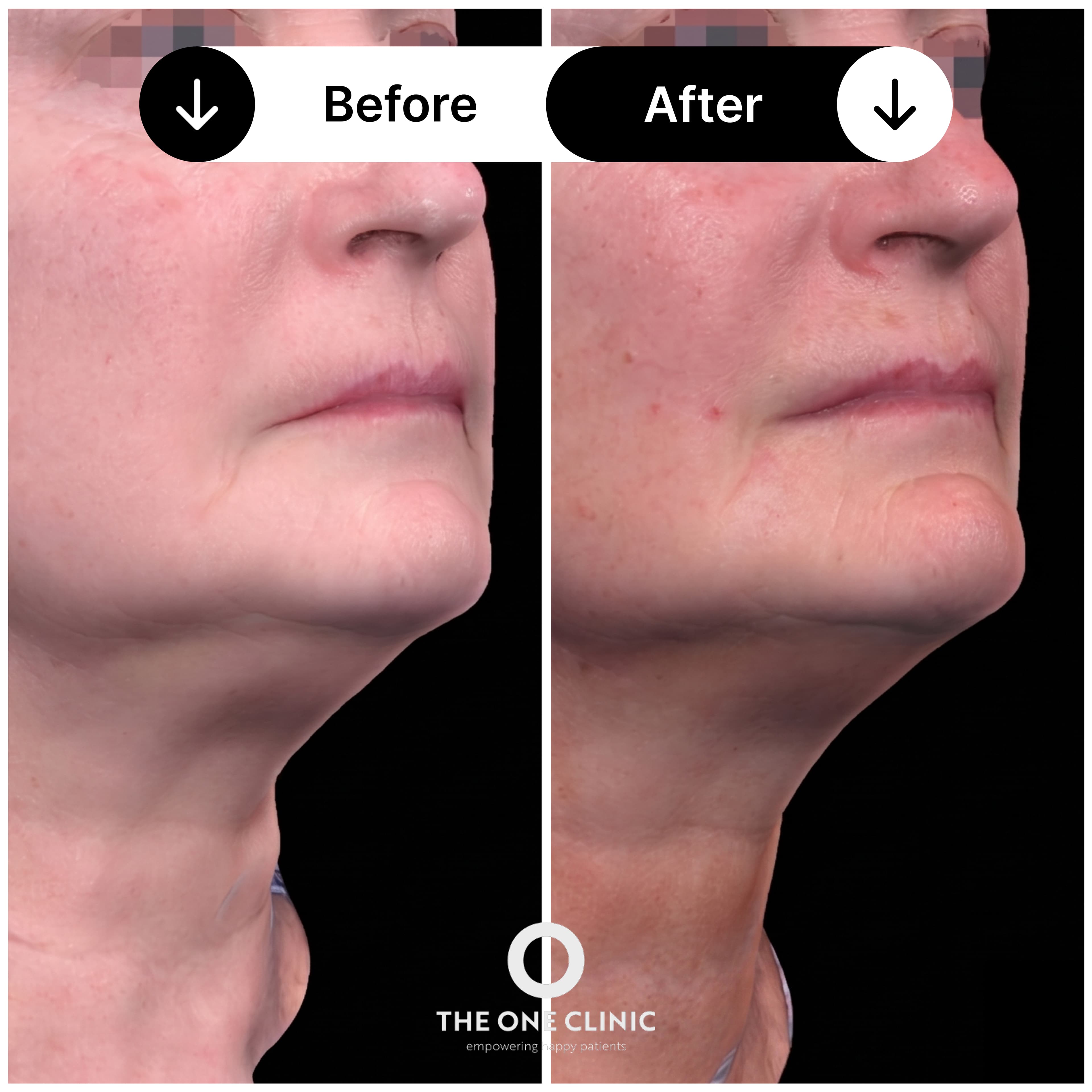 Morpheus8 before and after result 1